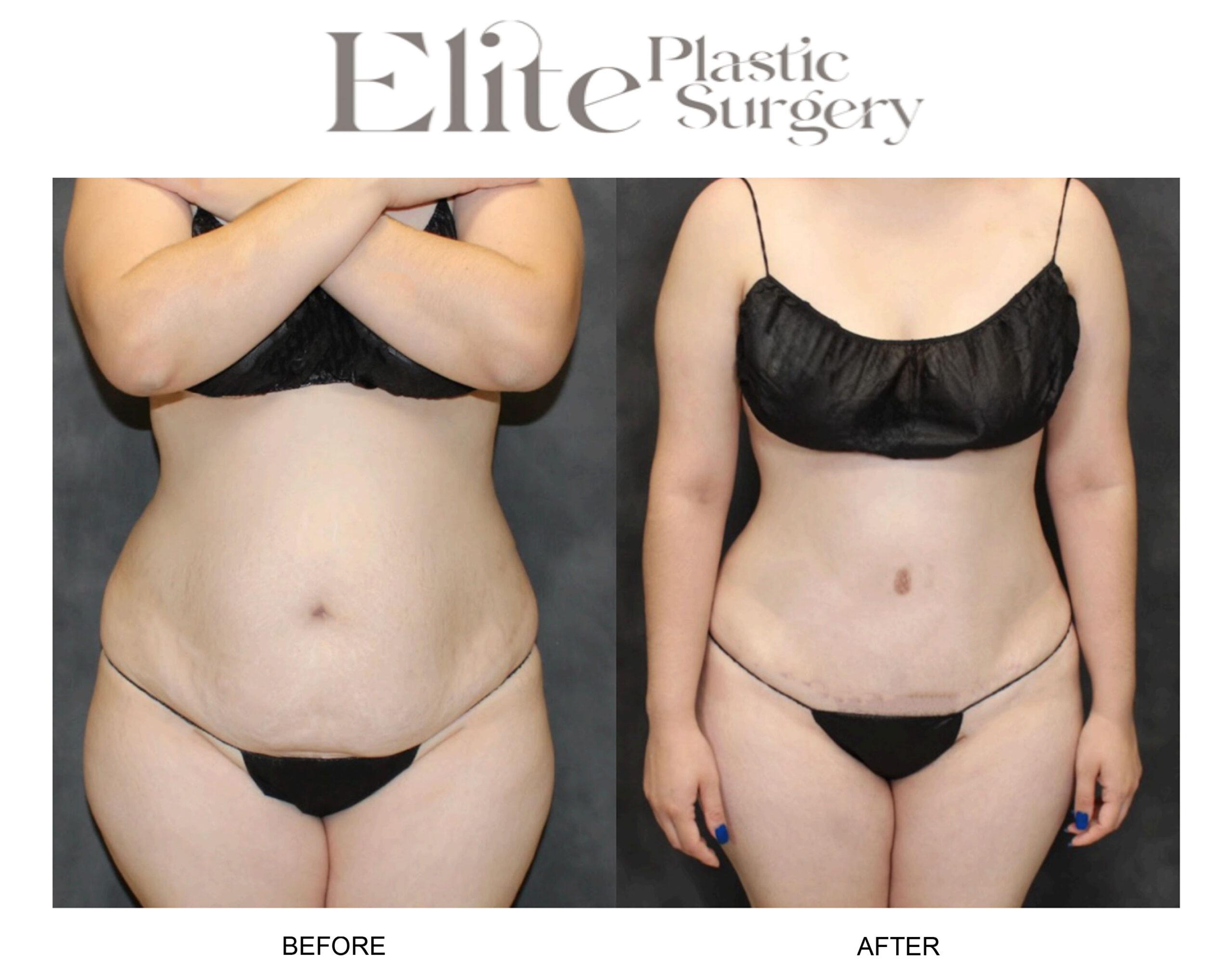 Abdominoplasty (Tummy Tuck) Before & After Gallery - Patient 712644 - Image 3