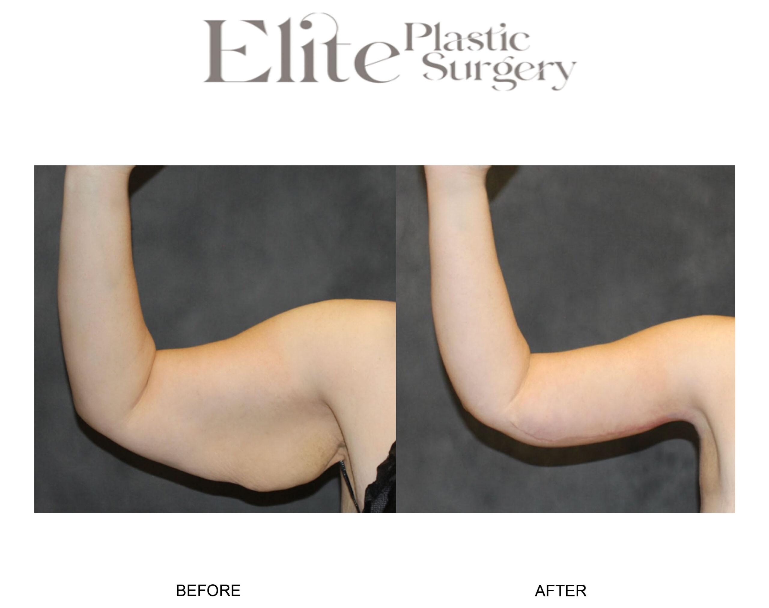 Brachioplasty (Arm Reduction) Before & After Gallery - Patient 406101 - Image 1