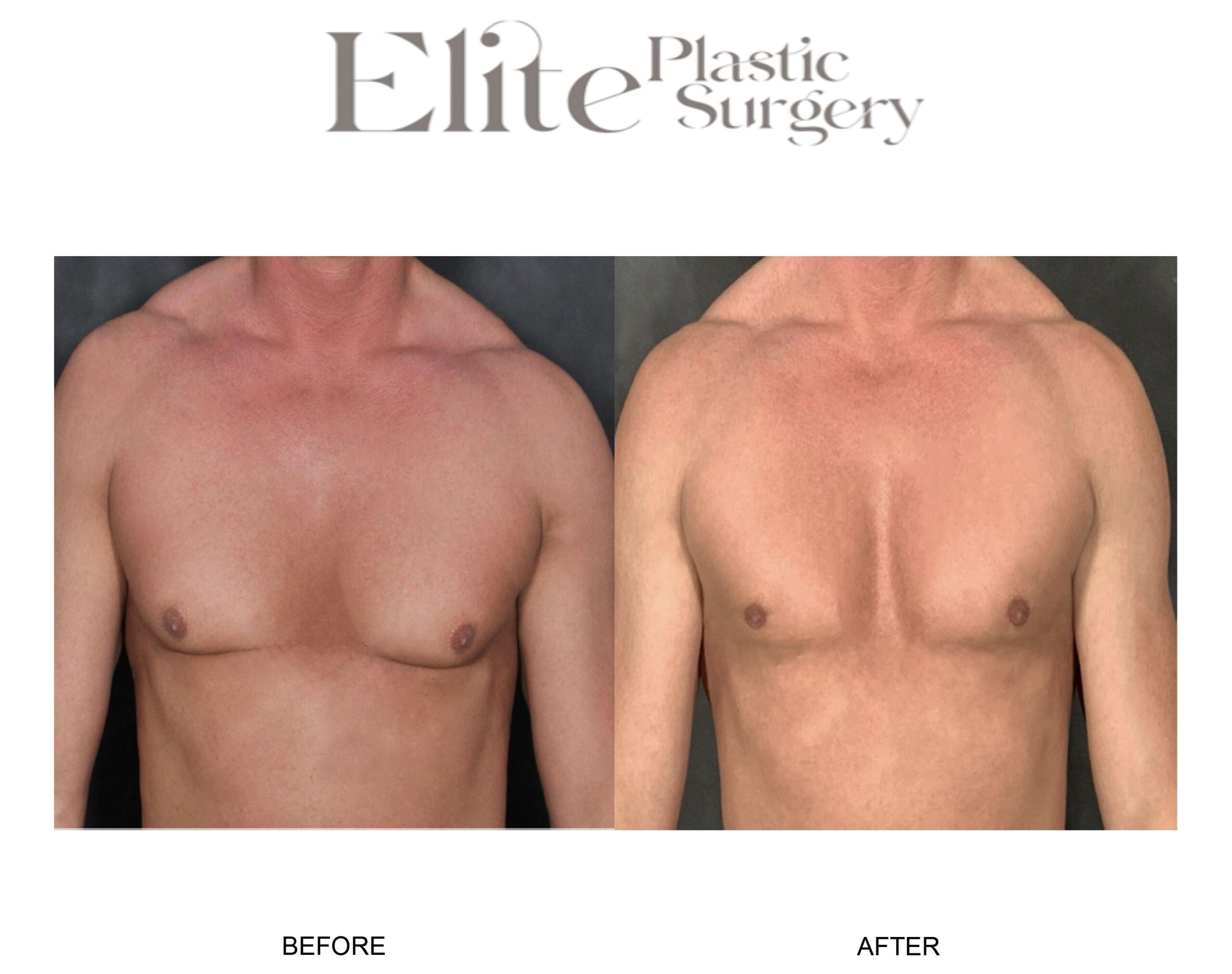 Male Gynecomastia Before & After Gallery - Patient 382441 - Image 1