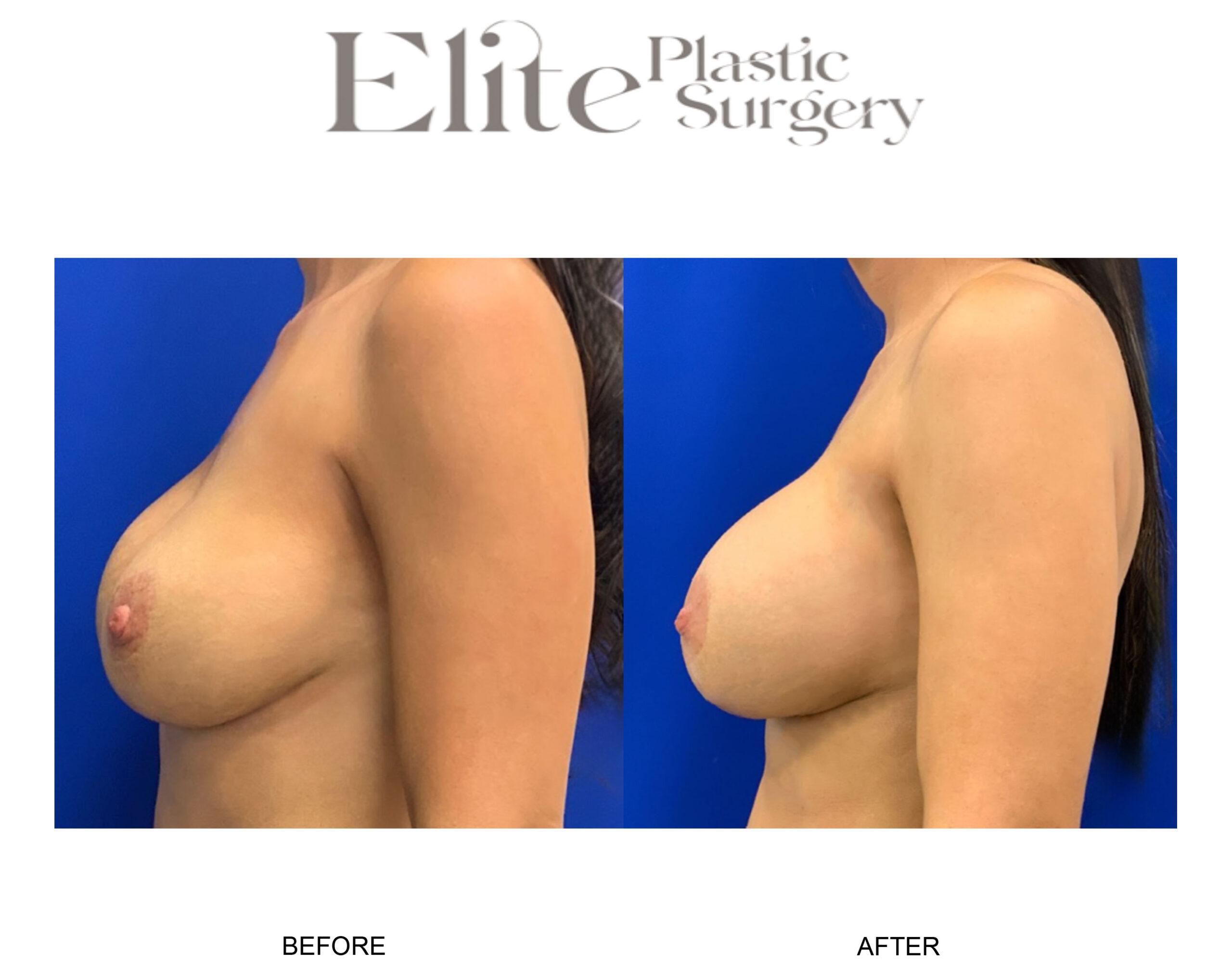 Breast Lift (Mastopexy) Before & After Gallery - Patient 114983 - Image 1