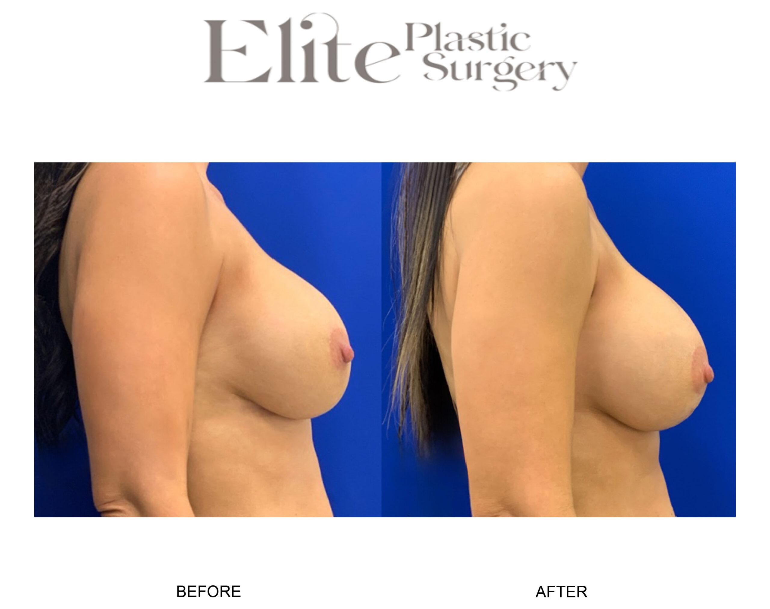 Breast Lift (Mastopexy) Before & After Gallery - Patient 114983 - Image 2