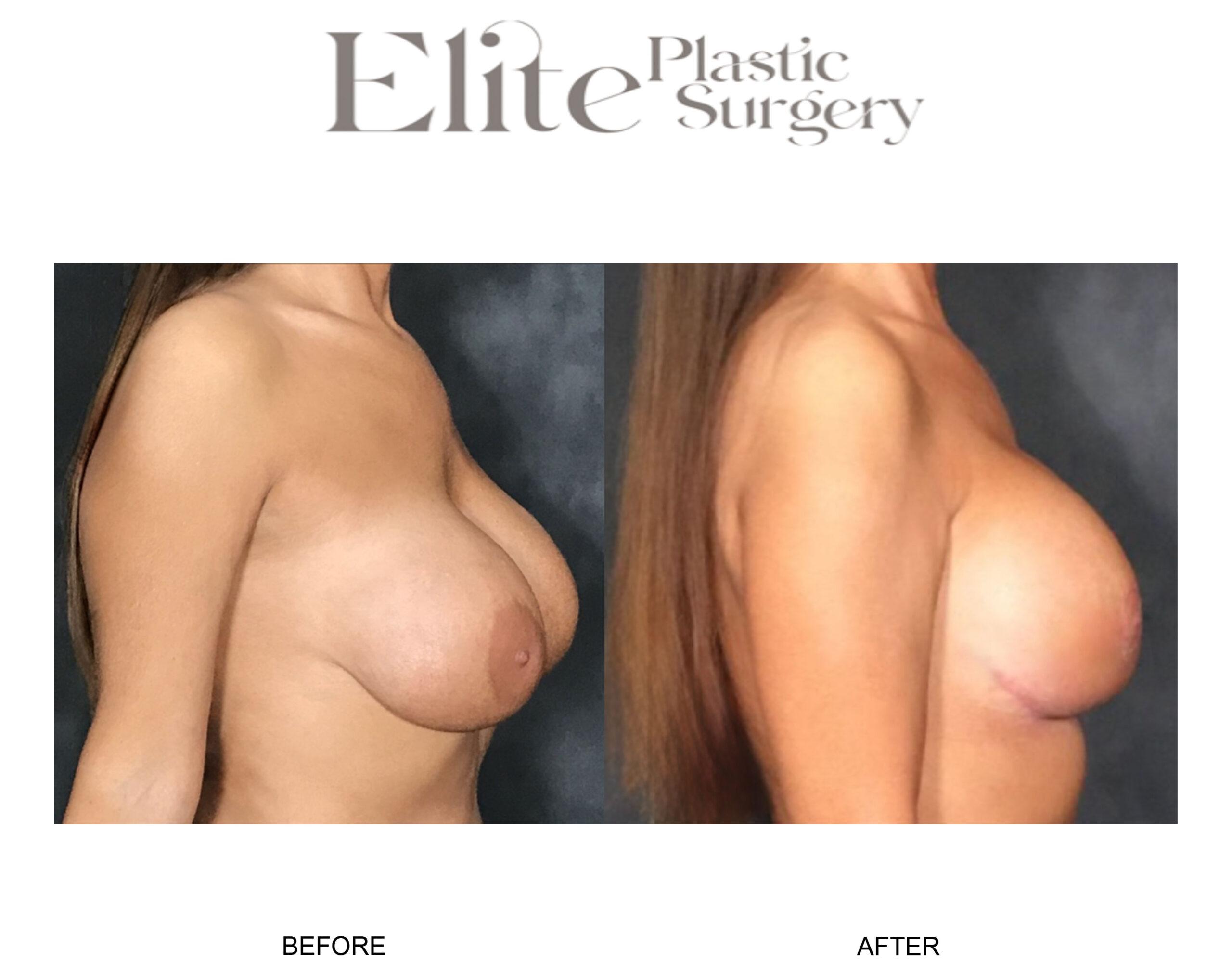 Breast Lift (Mastopexy) Before & After Gallery - Patient 115432 - Image 1