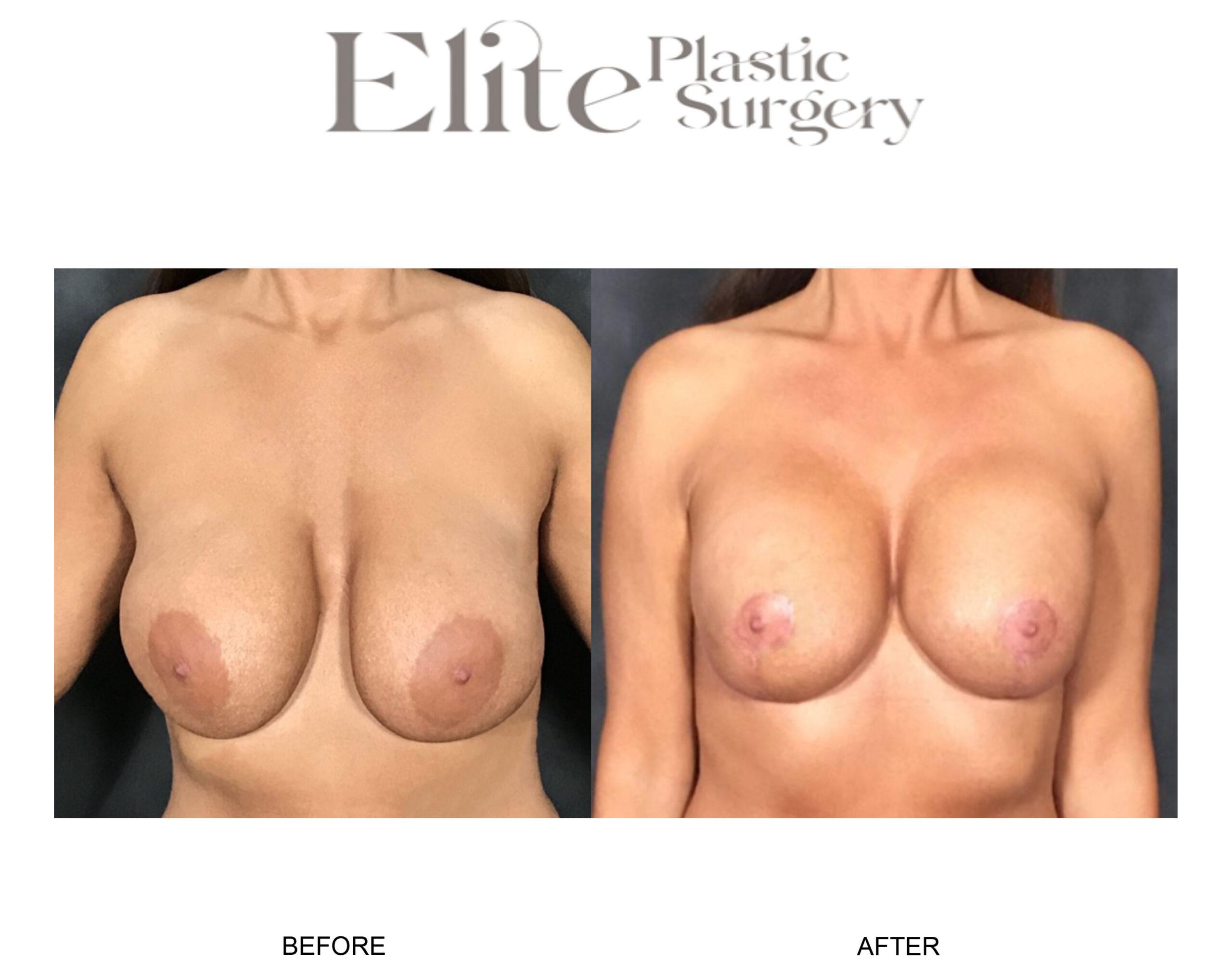 Breast Lift (Mastopexy) Before & After Gallery - Patient 115432 - Image 2