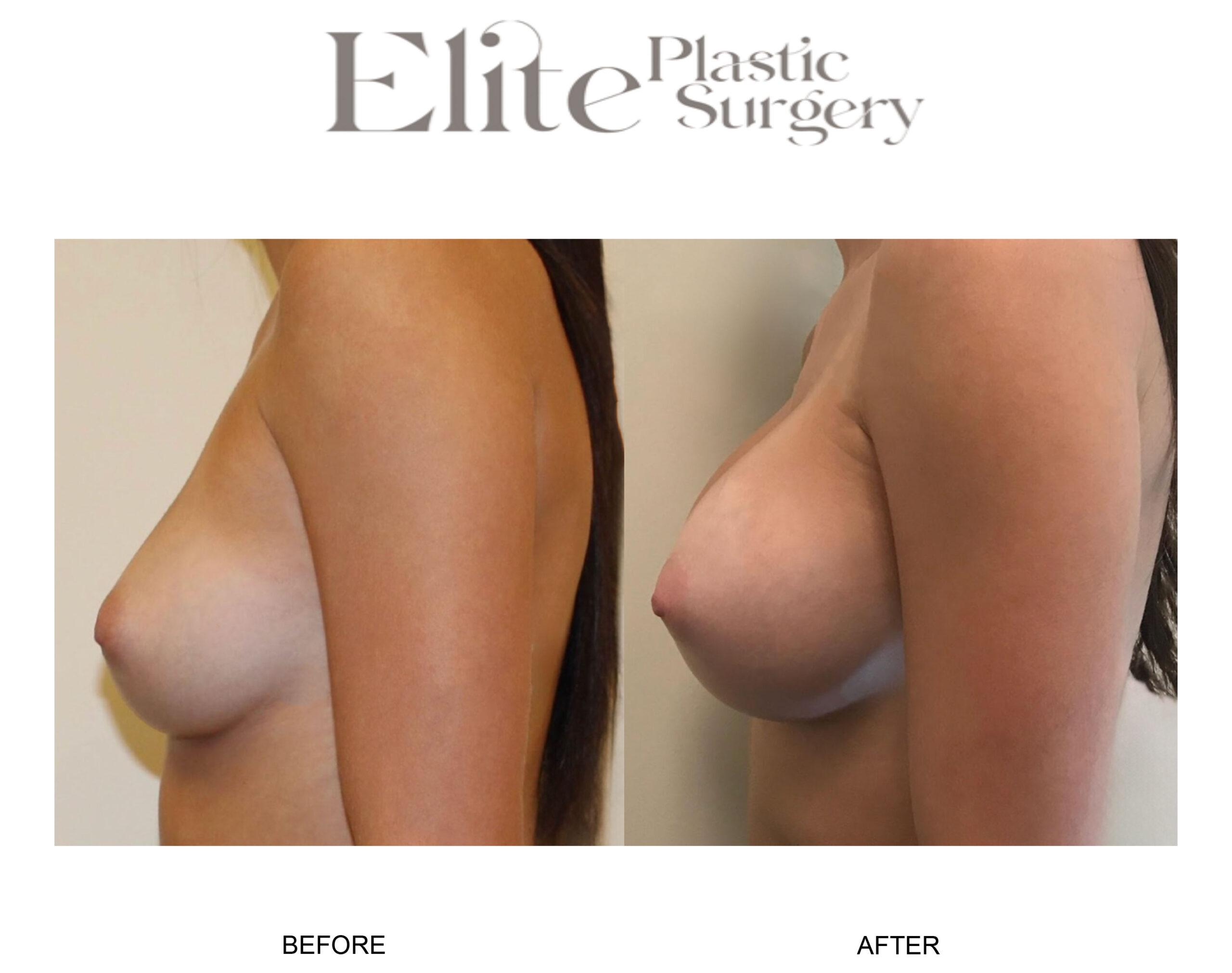 Breast Augmentation Before & After Gallery - Patient 372266 - Image 2