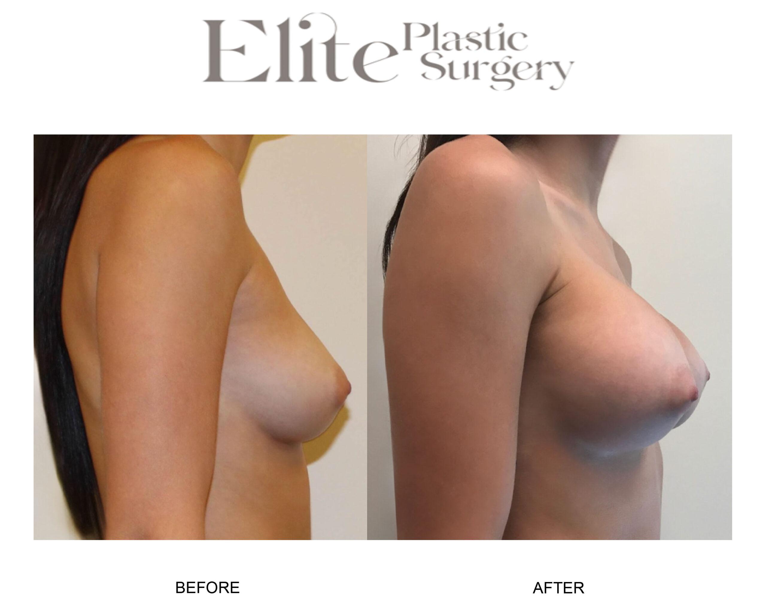 Breast Augmentation Before & After Gallery - Patient 372266 - Image 3
