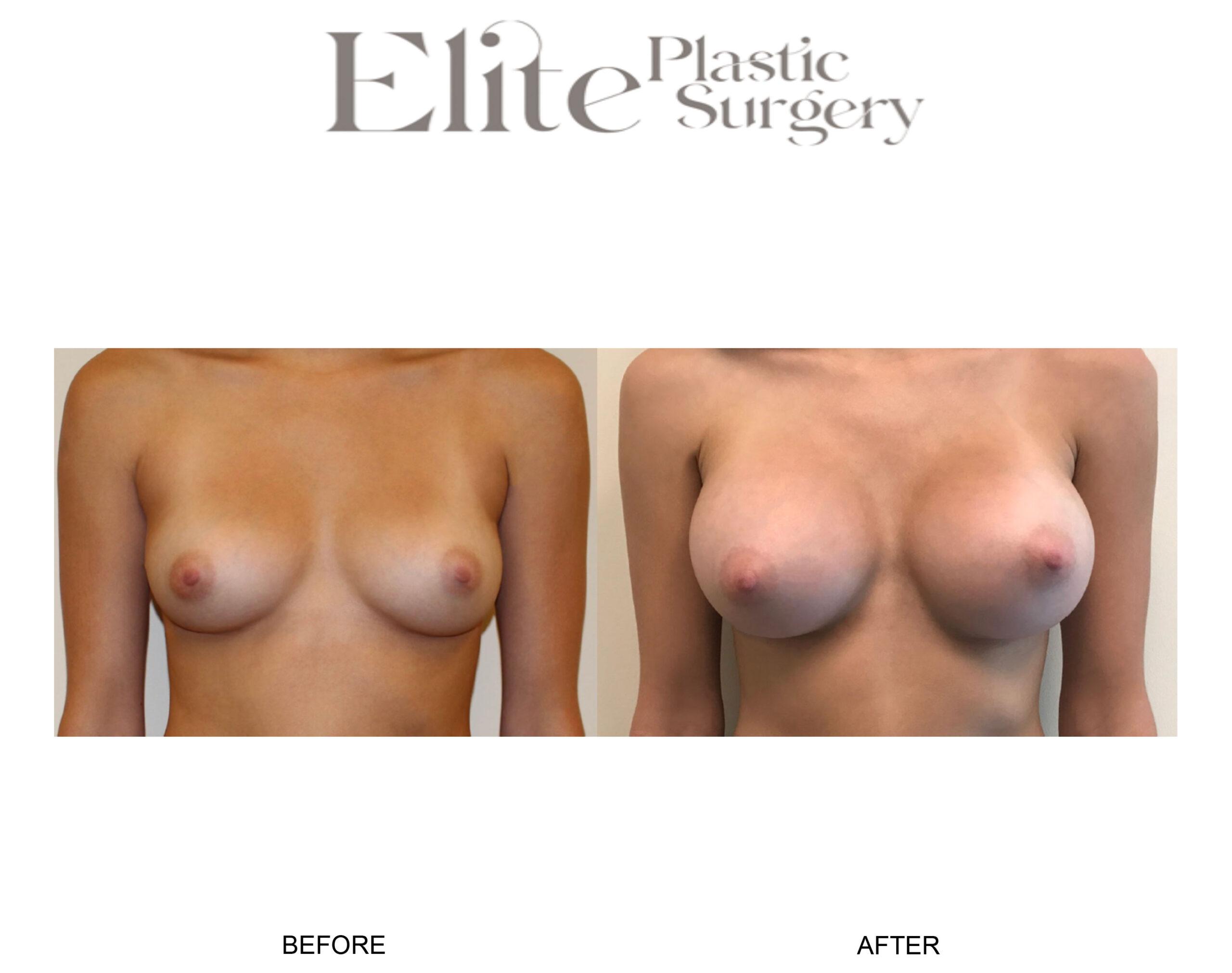 Breast Augmentation Before & After Gallery - Patient 372266 - Image 1