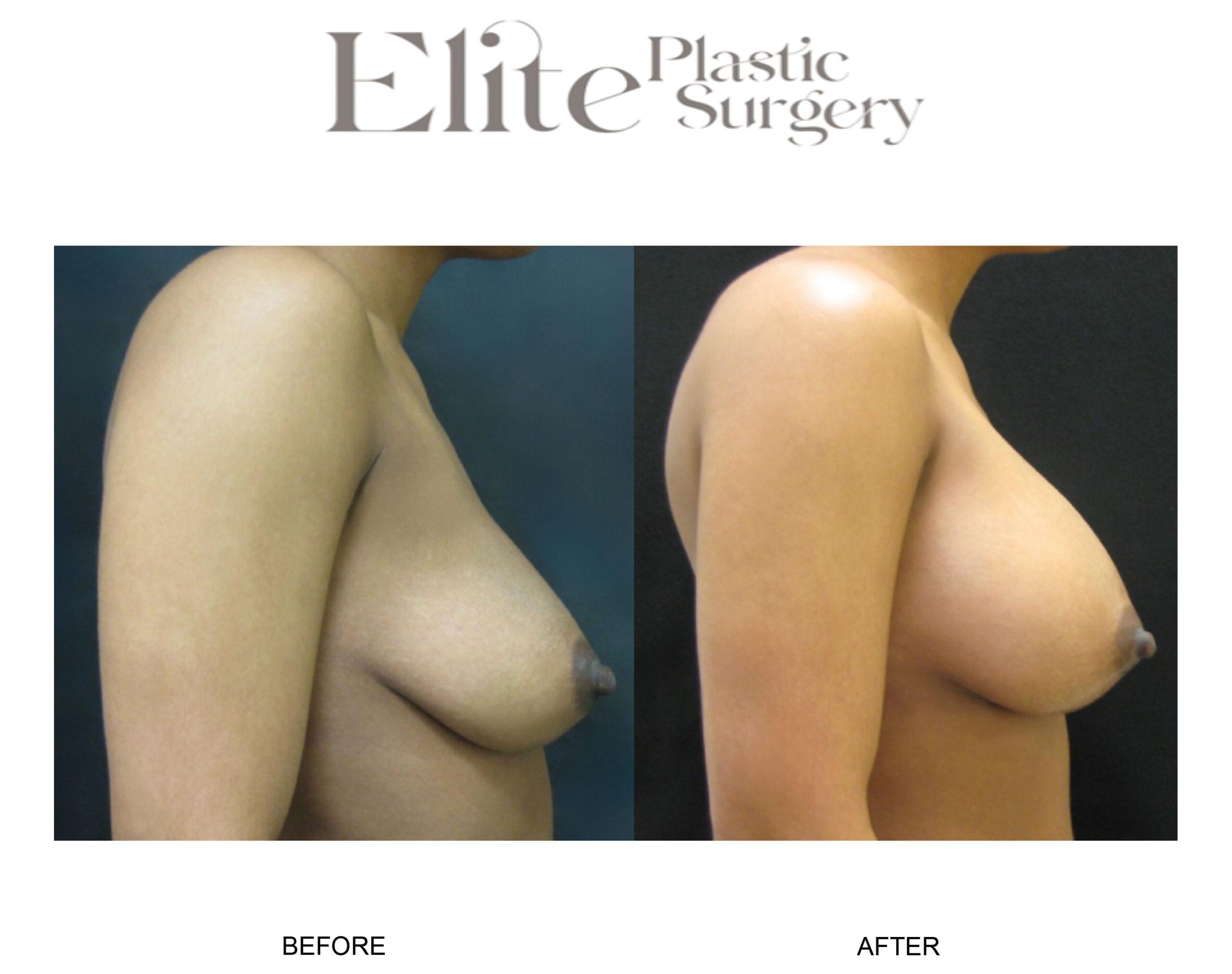Breast Augmentation Before & After Gallery - Patient 247079 - Image 2