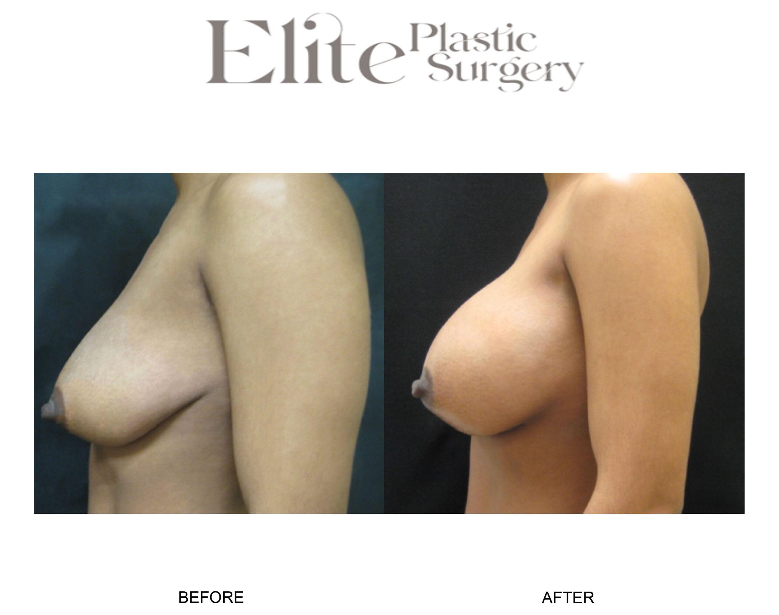 Breast Augmentation Before & After Gallery - Patient 247079 - Image 3