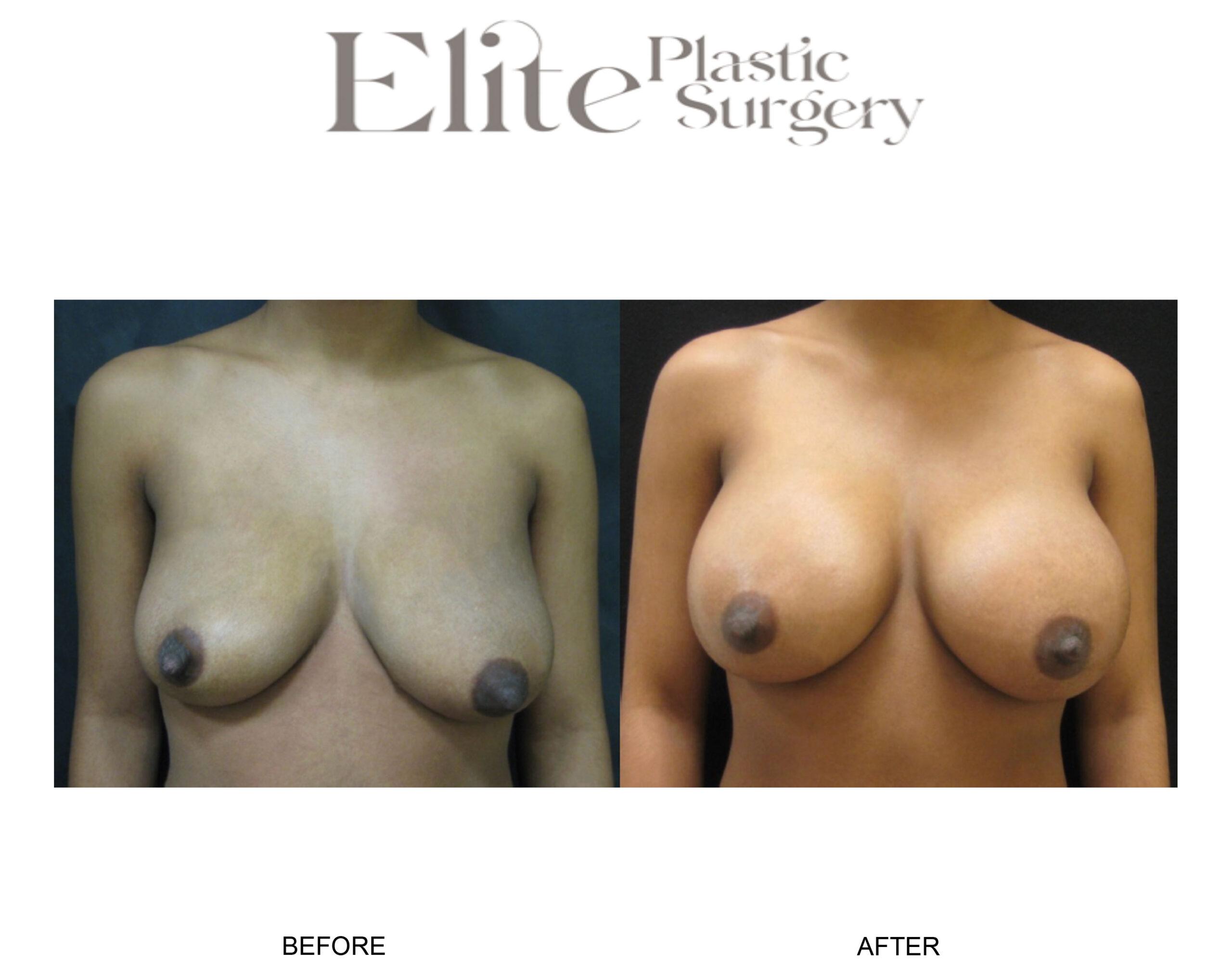 Breast Augmentation Before & After Gallery - Patient 247079 - Image 1