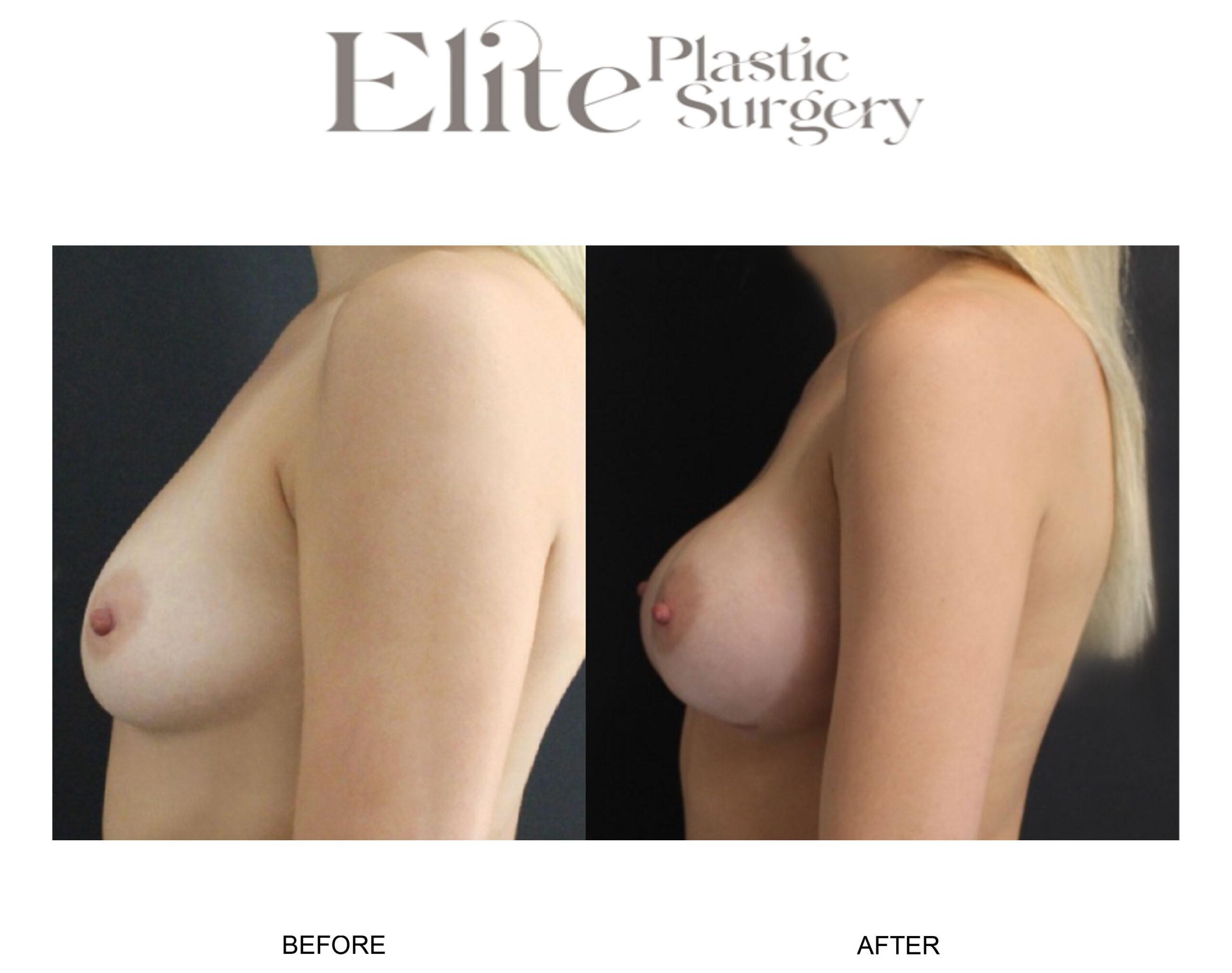 Breast Augmentation Before & After Gallery - Patient 778636 - Image 2