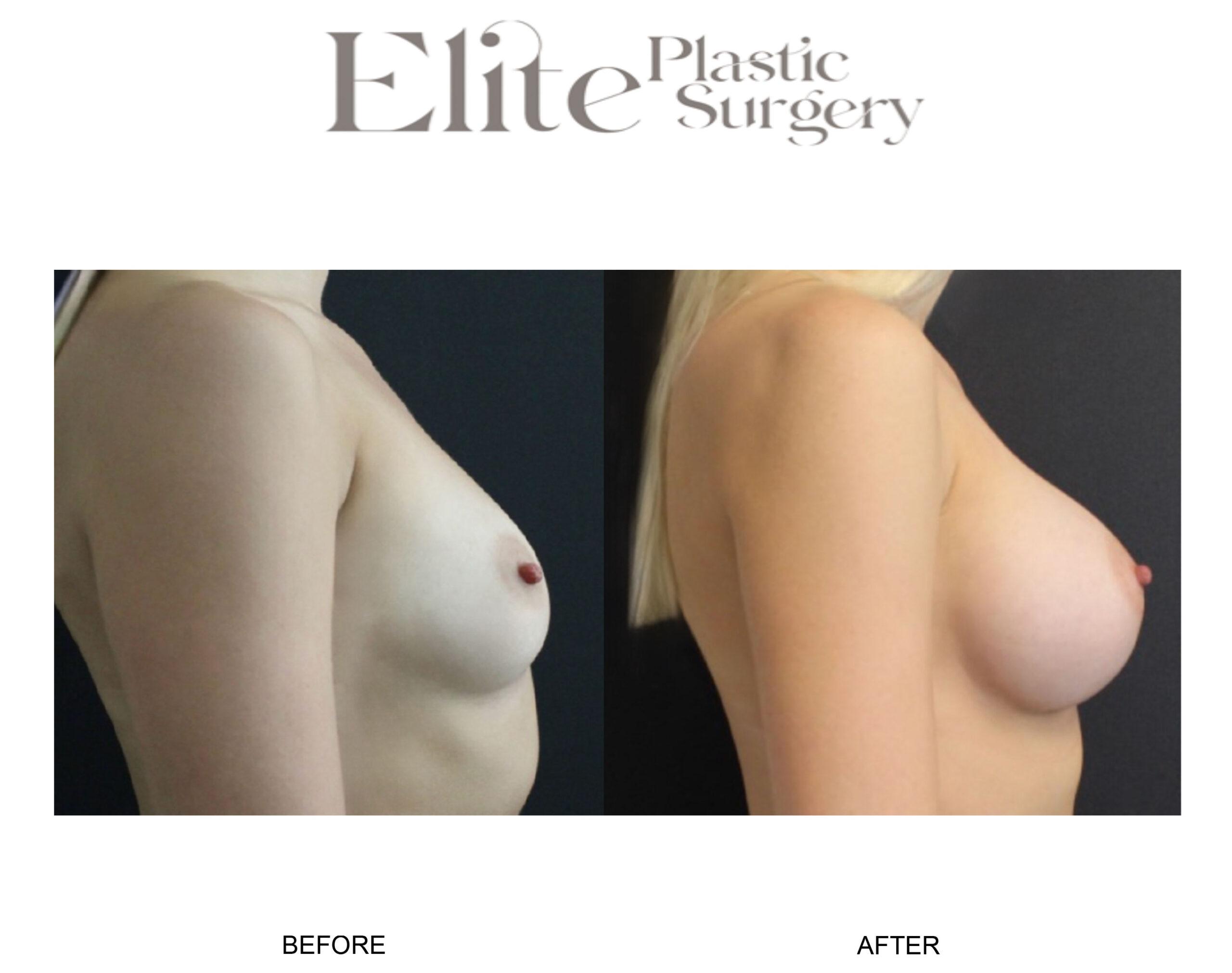Breast Augmentation Before & After Gallery - Patient 778636 - Image 3