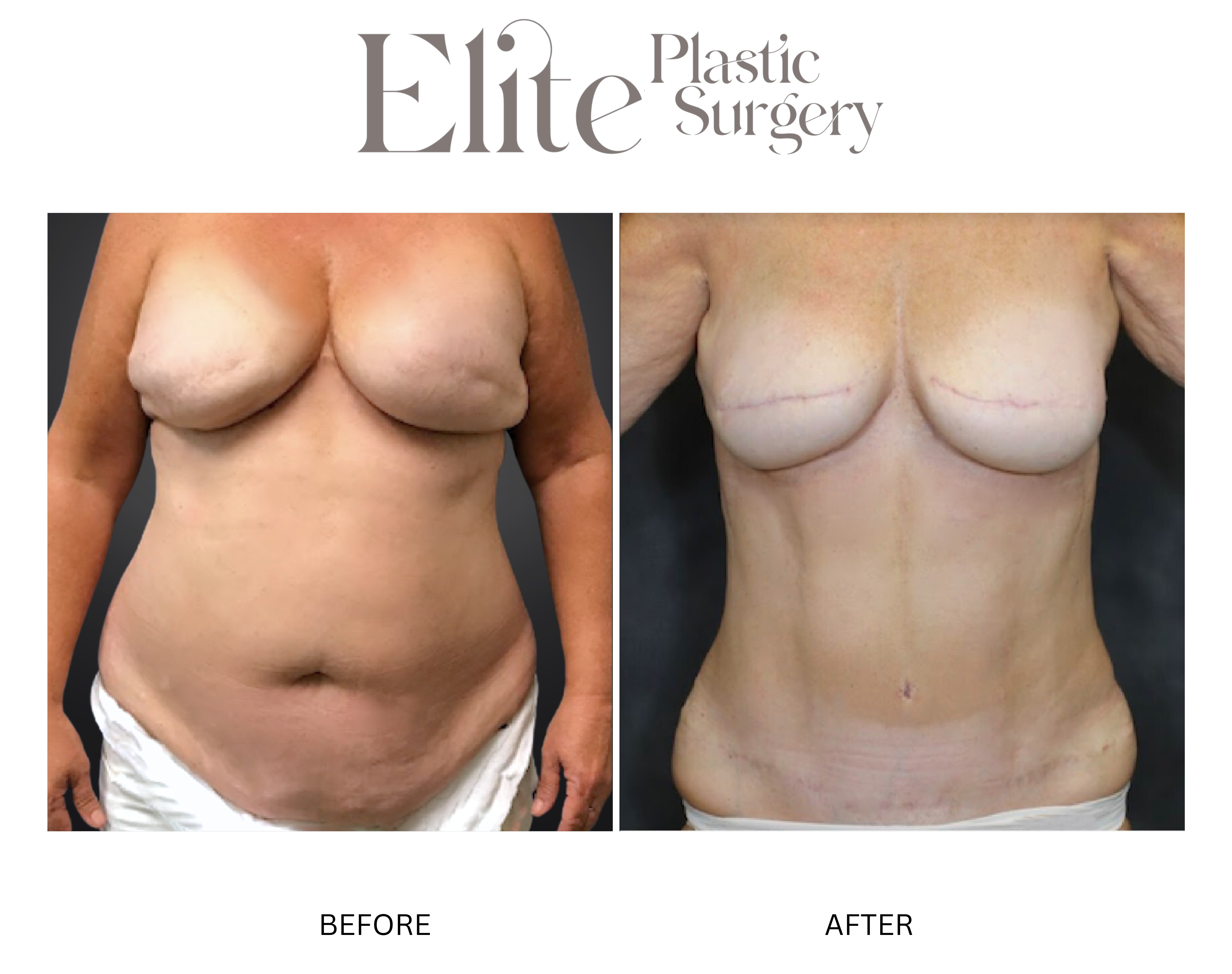 DIEP Breast Reconstruction Before & After Gallery - Patient 301516 - Image 1