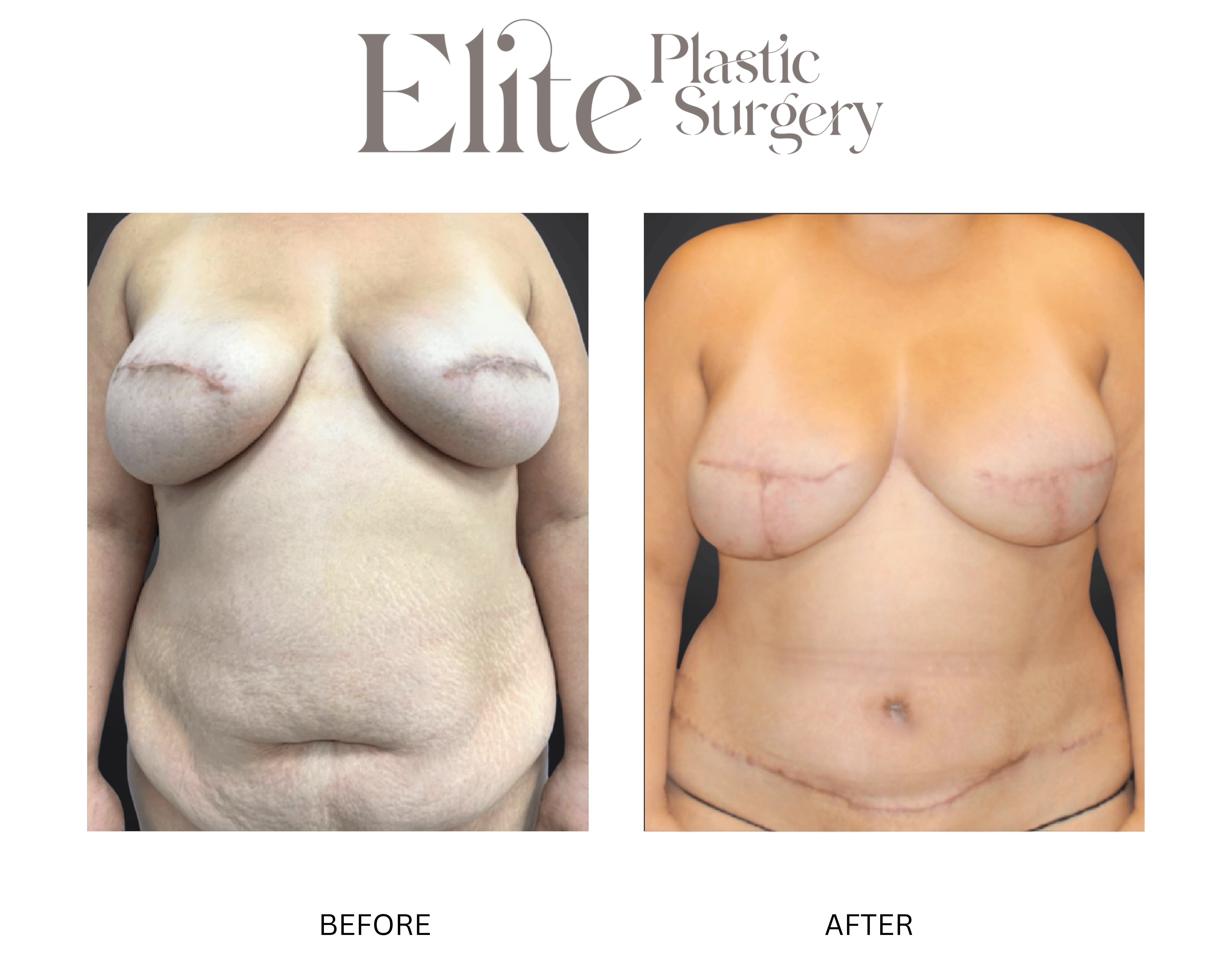 DIEP Breast Reconstruction Before & After Gallery - Patient 336048 - Image 1