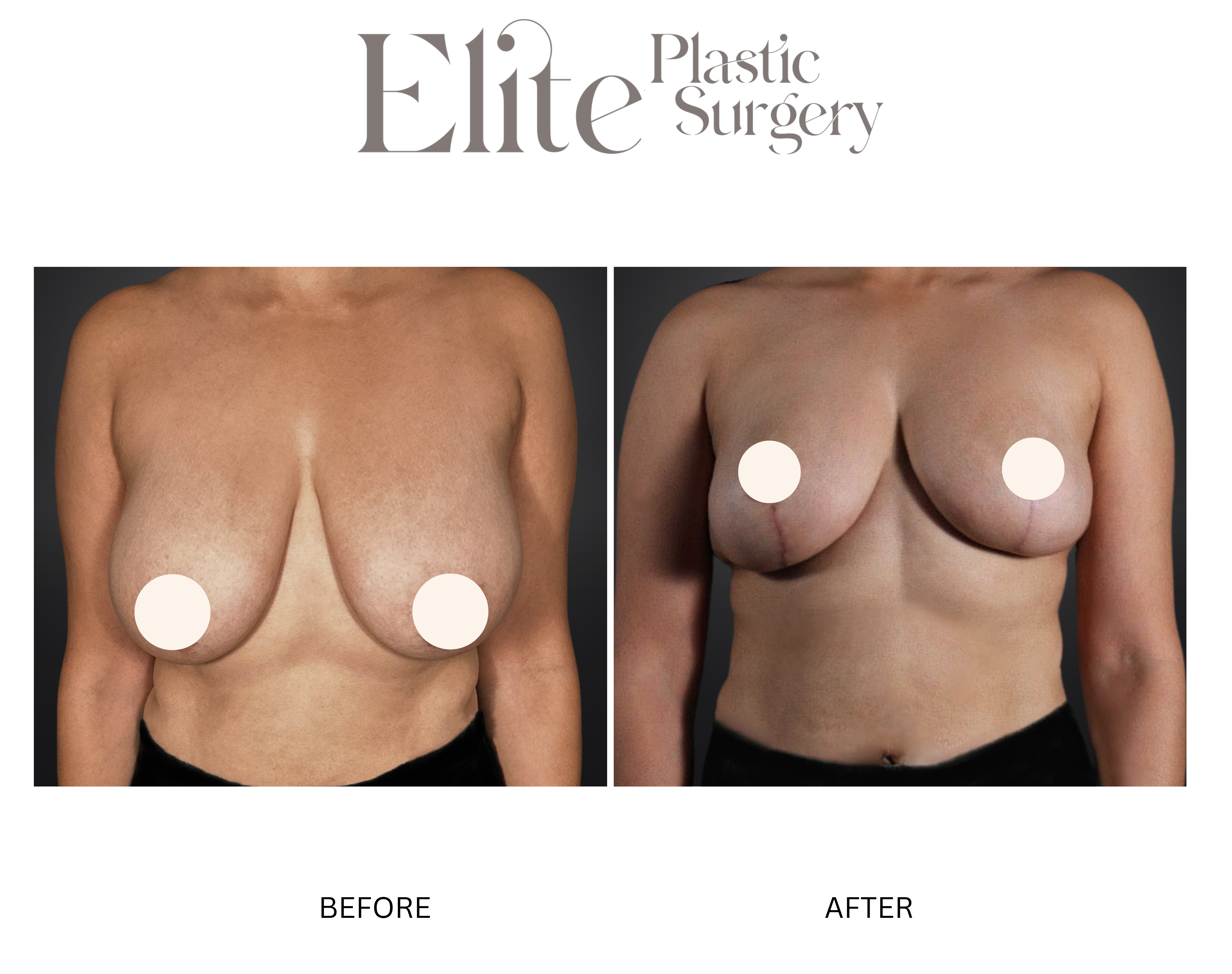 Breast Reduction Before & After Gallery - Patient 461357 - Image 1