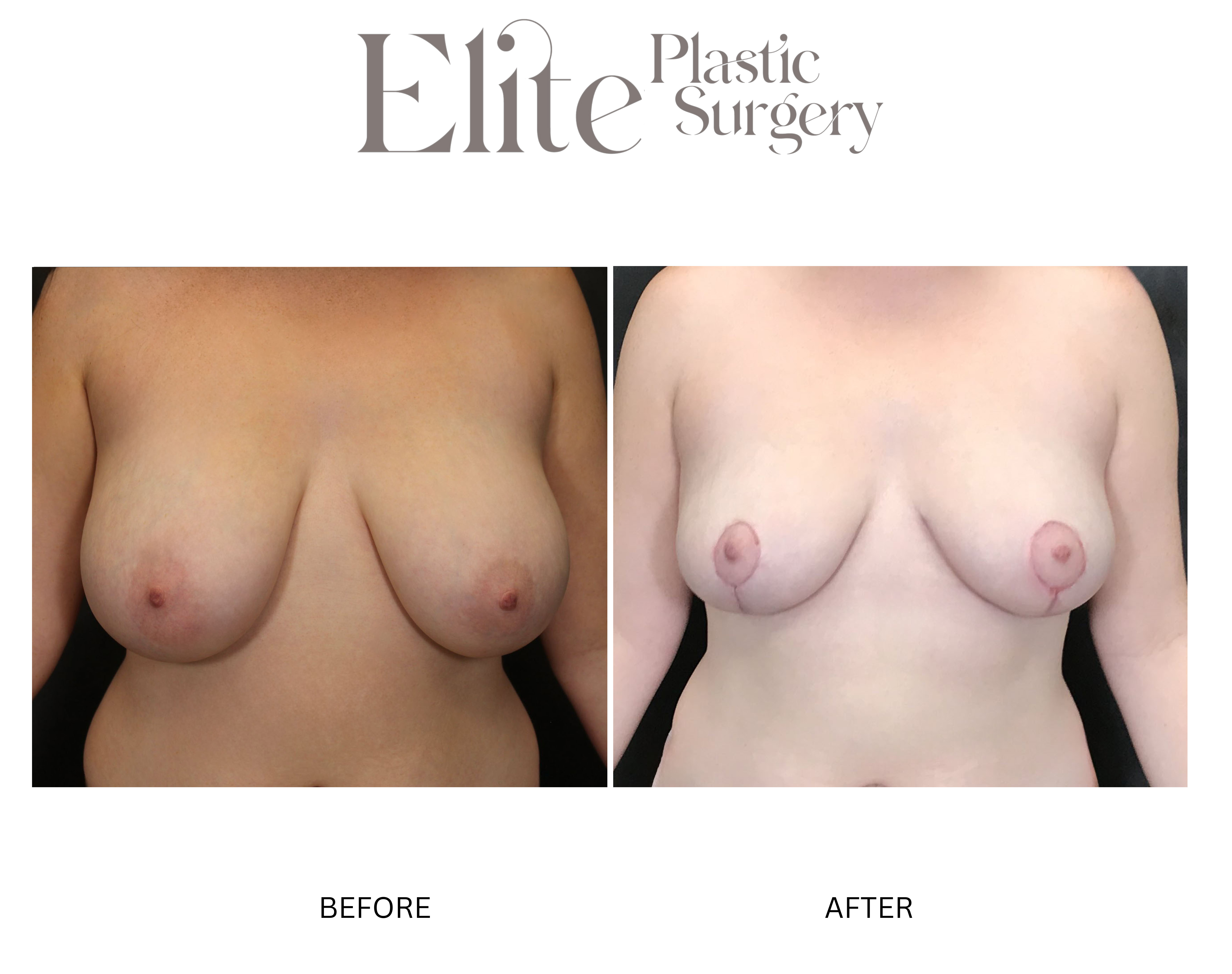 Breast Reduction Before & After Gallery - Patient 284091 - Image 1