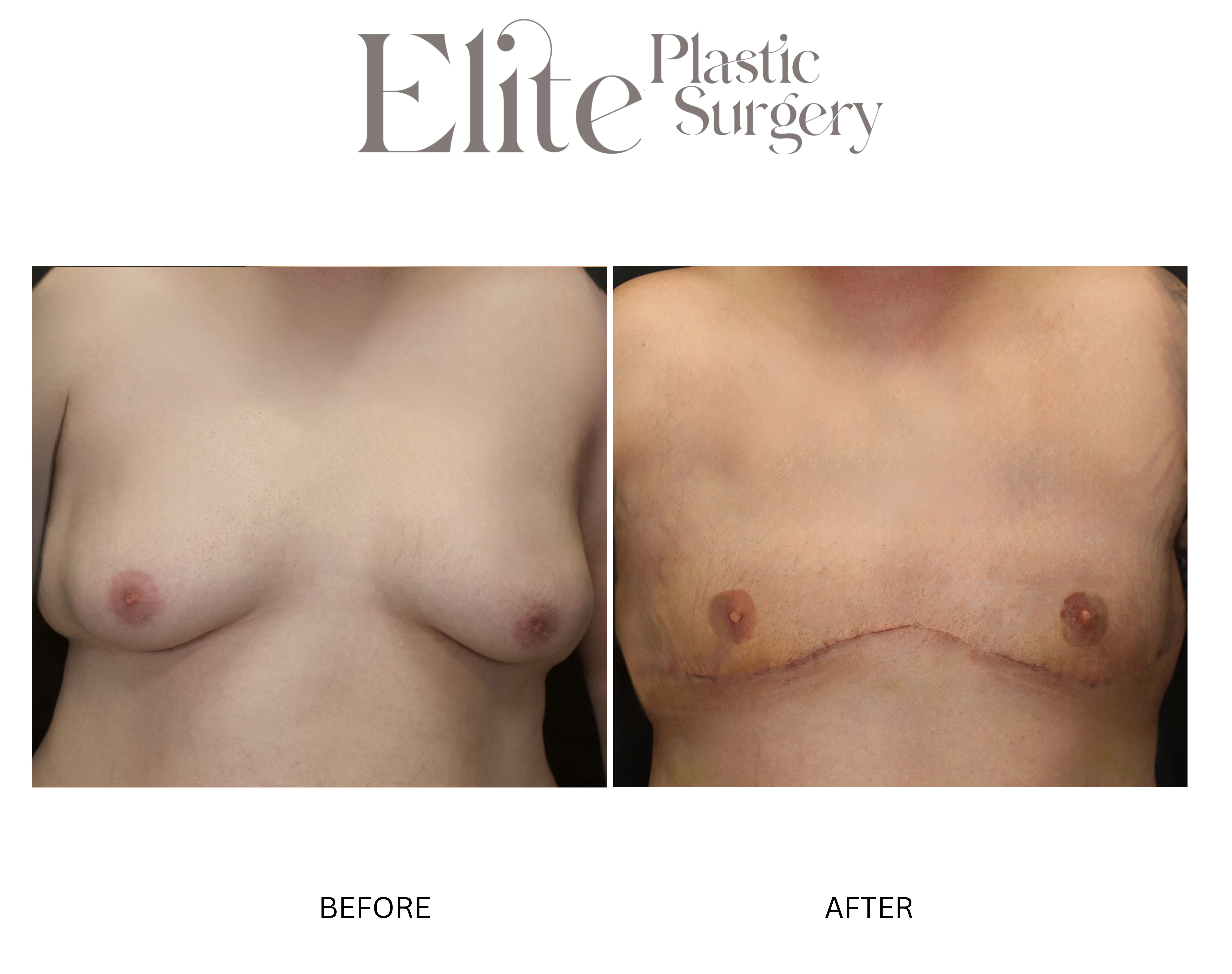 Male Gynecomastia Before & After Gallery - Patient 367506 - Image 1