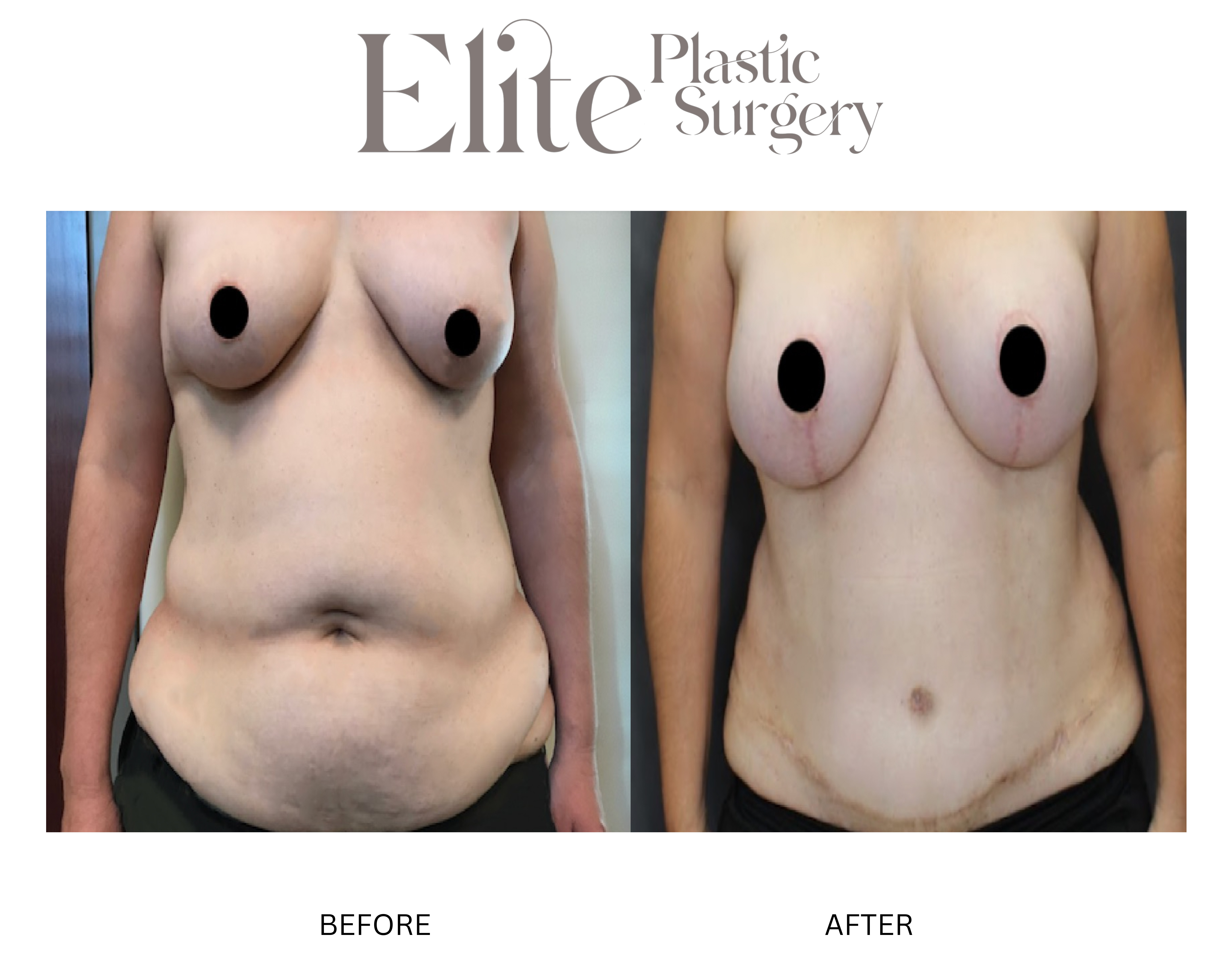 DIEP Breast Reconstruction Before & After Gallery - Patient 409146 - Image 1