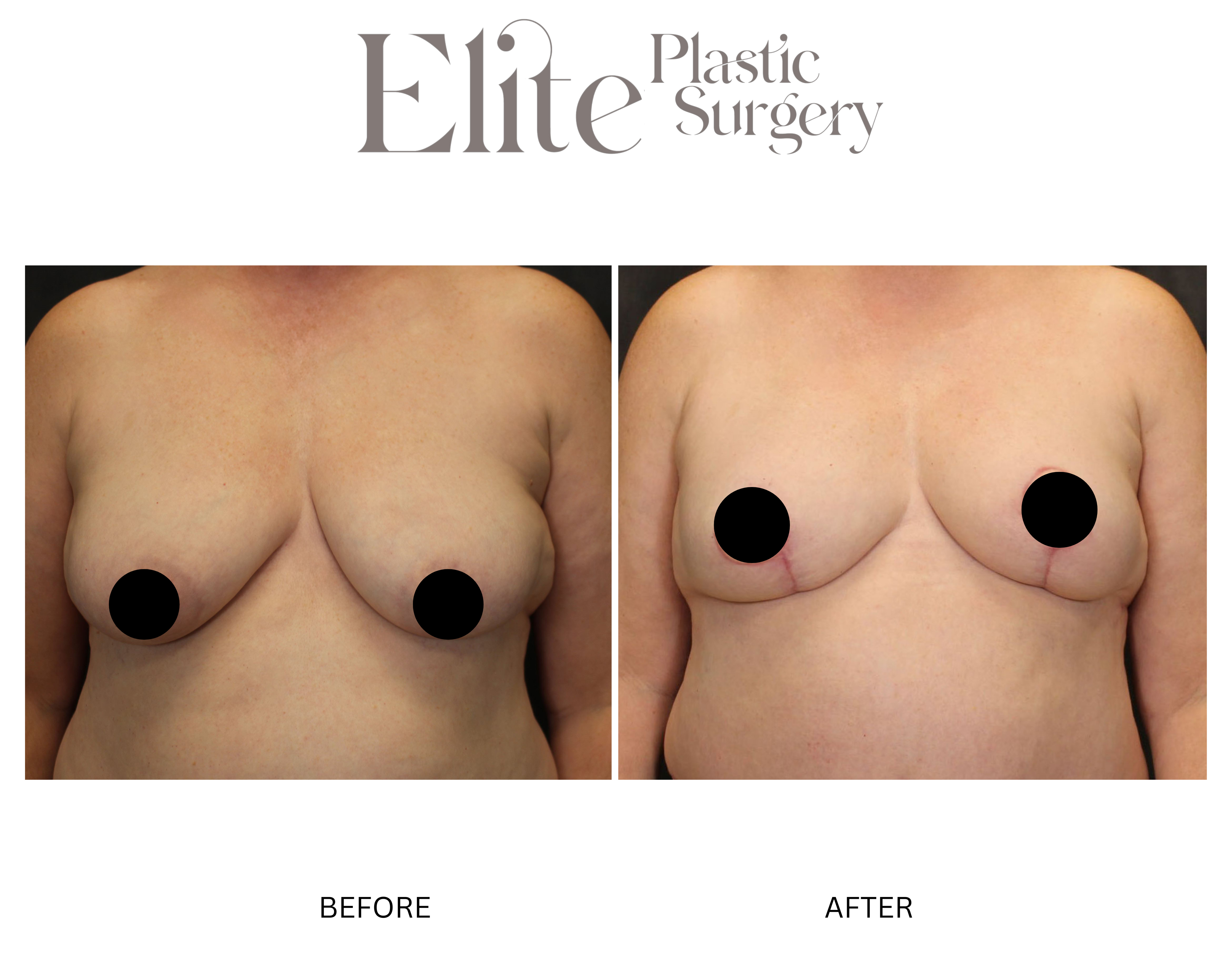 DIEP Breast Reconstruction Before & After Gallery - Patient 118382 - Image 1