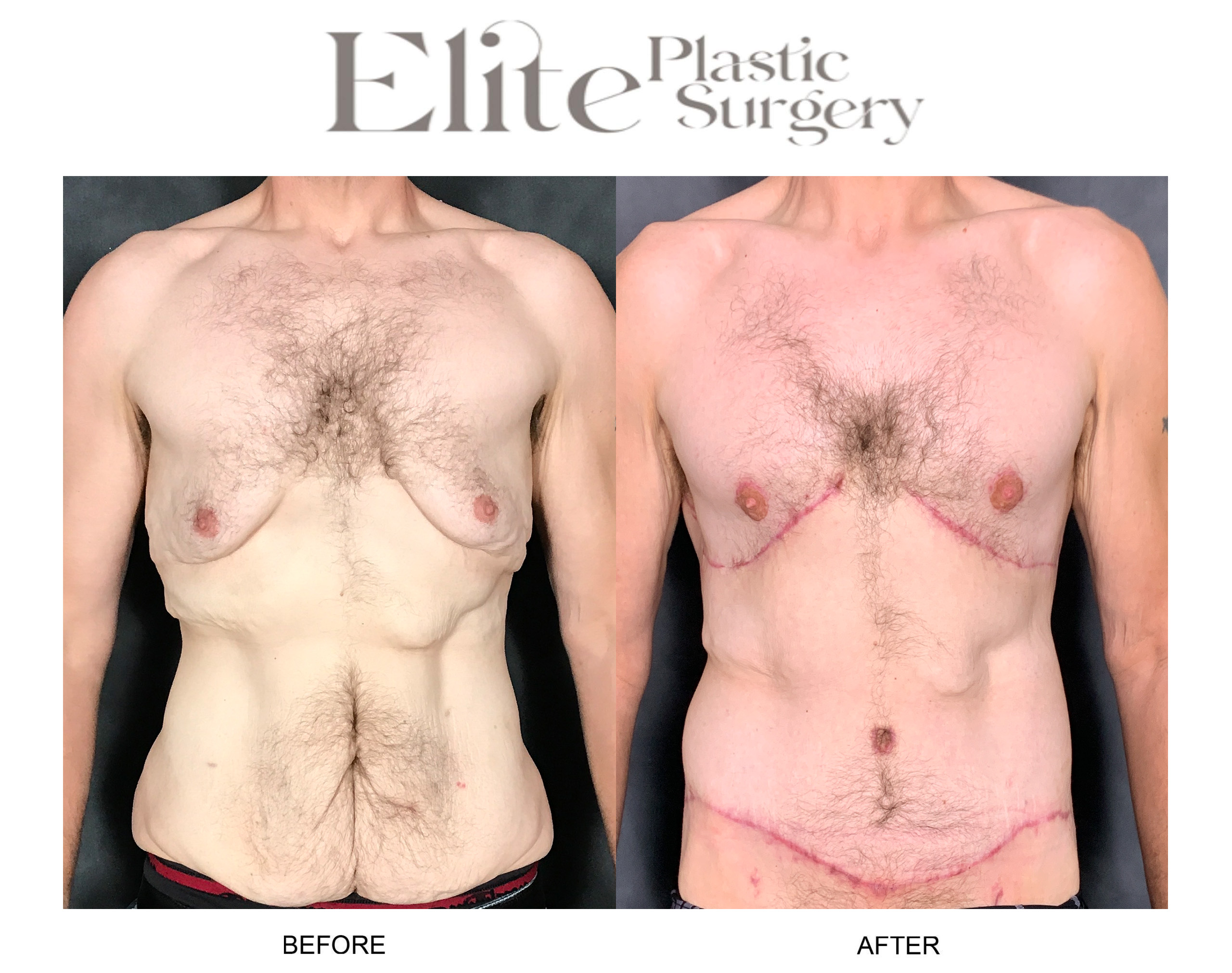 Body Lift (Surgery after Excessive Weightloss) Before & After Gallery - Patient 267114 - Image 1