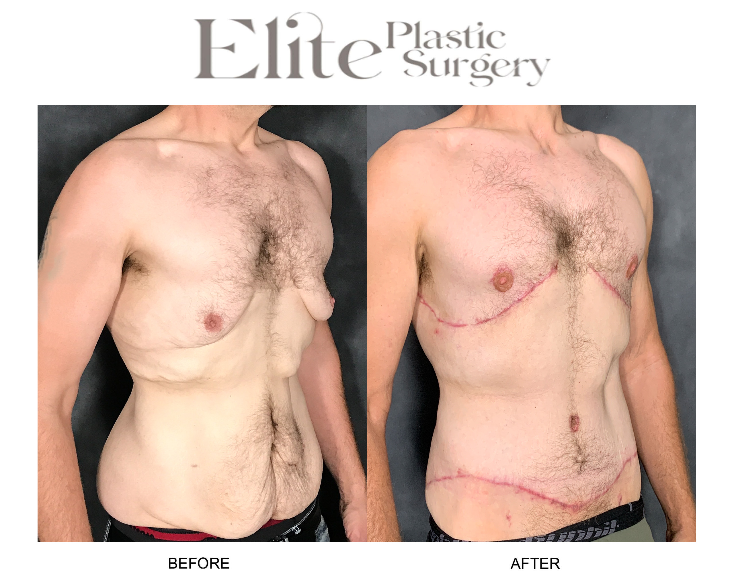 Body Lift (Surgery after Excessive Weightloss) Before & After Gallery - Patient 267114 - Image 2