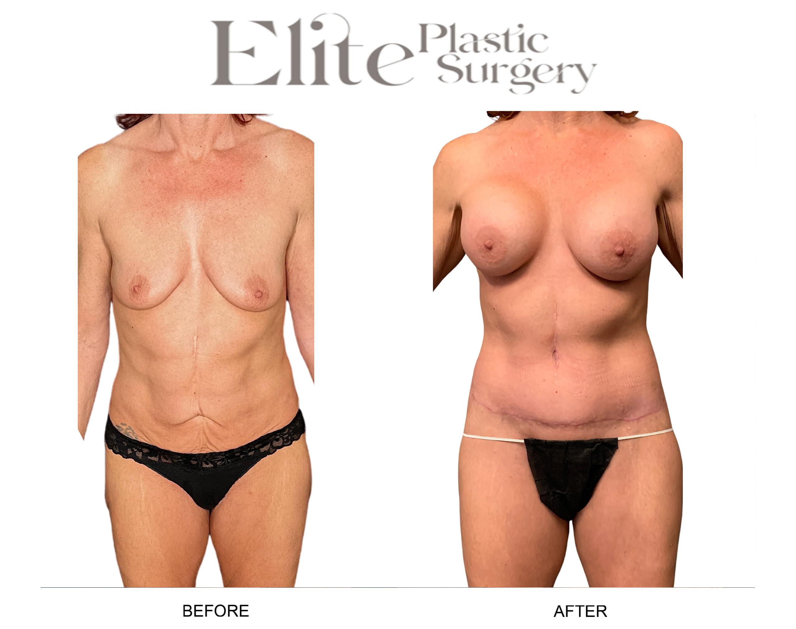 Body Lift (Surgery after Excessive Weightloss) Before & After Gallery - Patient 328821 - Image 1