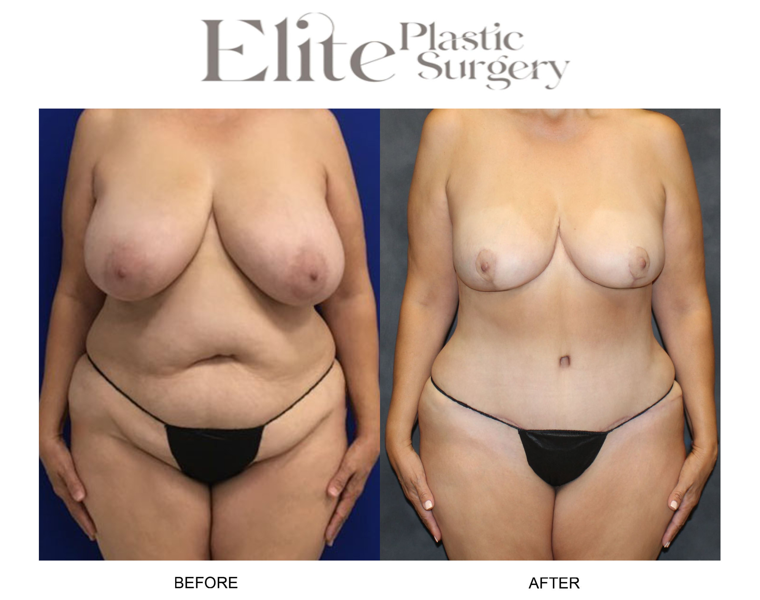 Mommy Makeover Before & After Gallery - Patient 398594 - Image 1