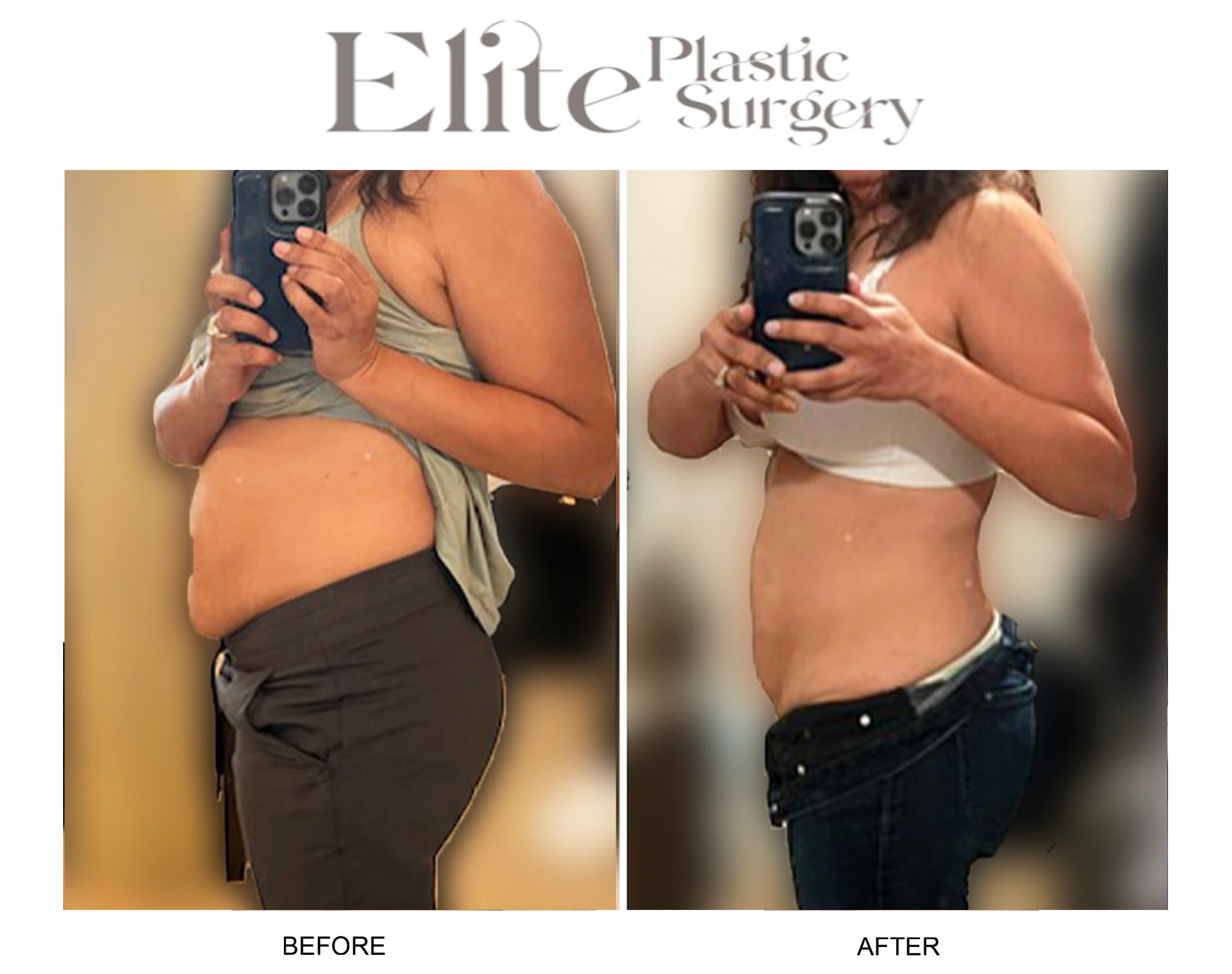 Weight Loss Shots Before & After Gallery - Patient 179556 - Image 1