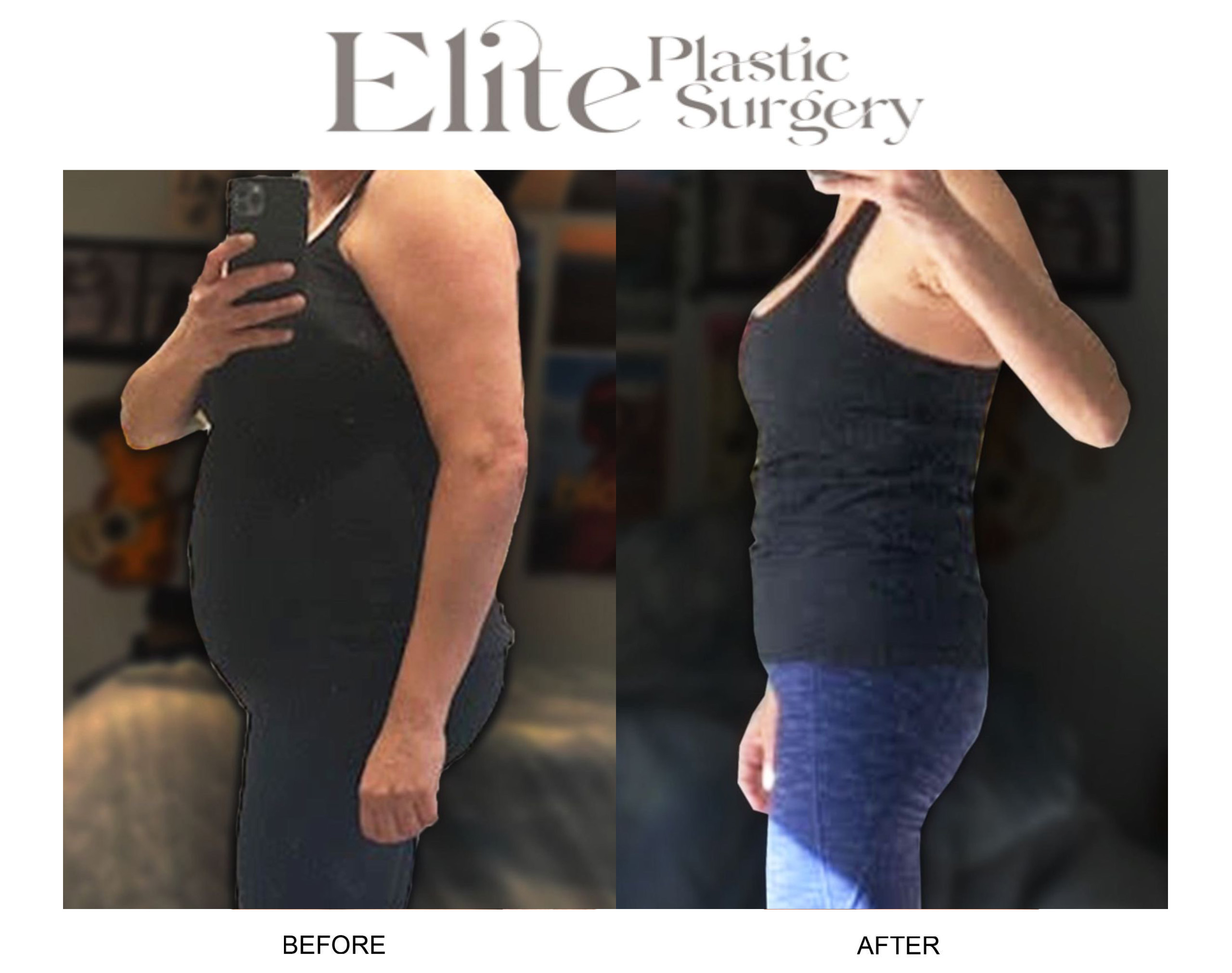 Weight Loss Shots Before & After Gallery - Patient 308736 - Image 1