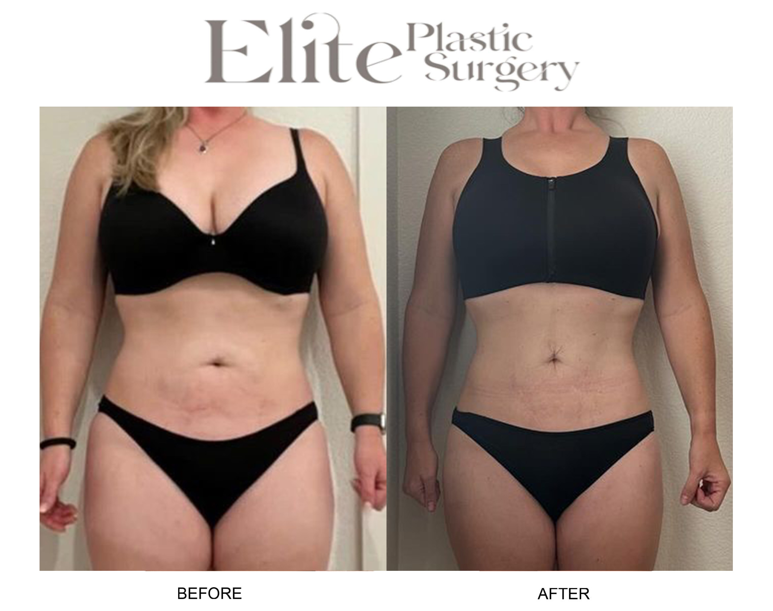 Weight Loss Shots Before & After Gallery - Patient 263770 - Image 1