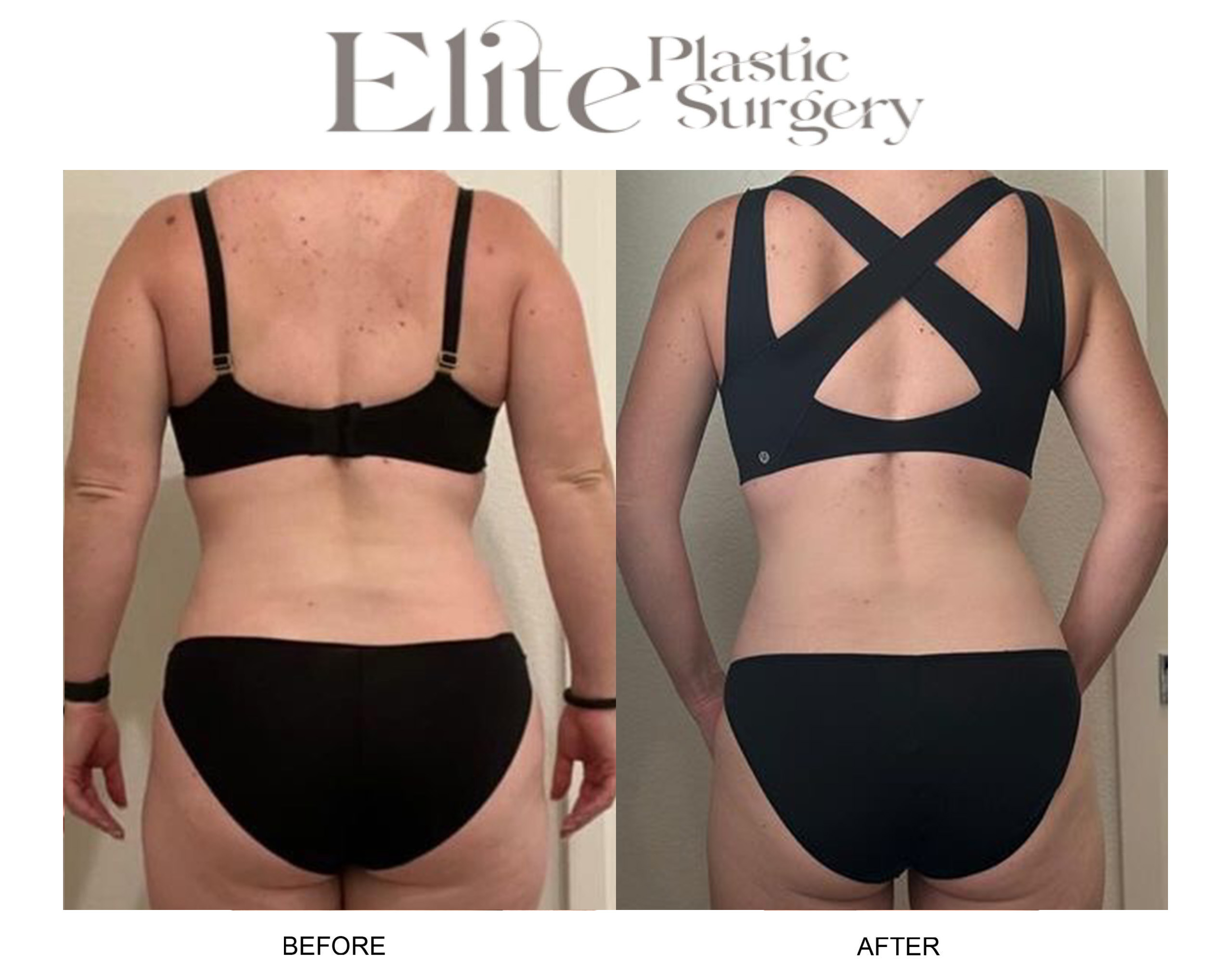 Weight Loss Shots Before & After Gallery - Patient 154434 - Image 1
