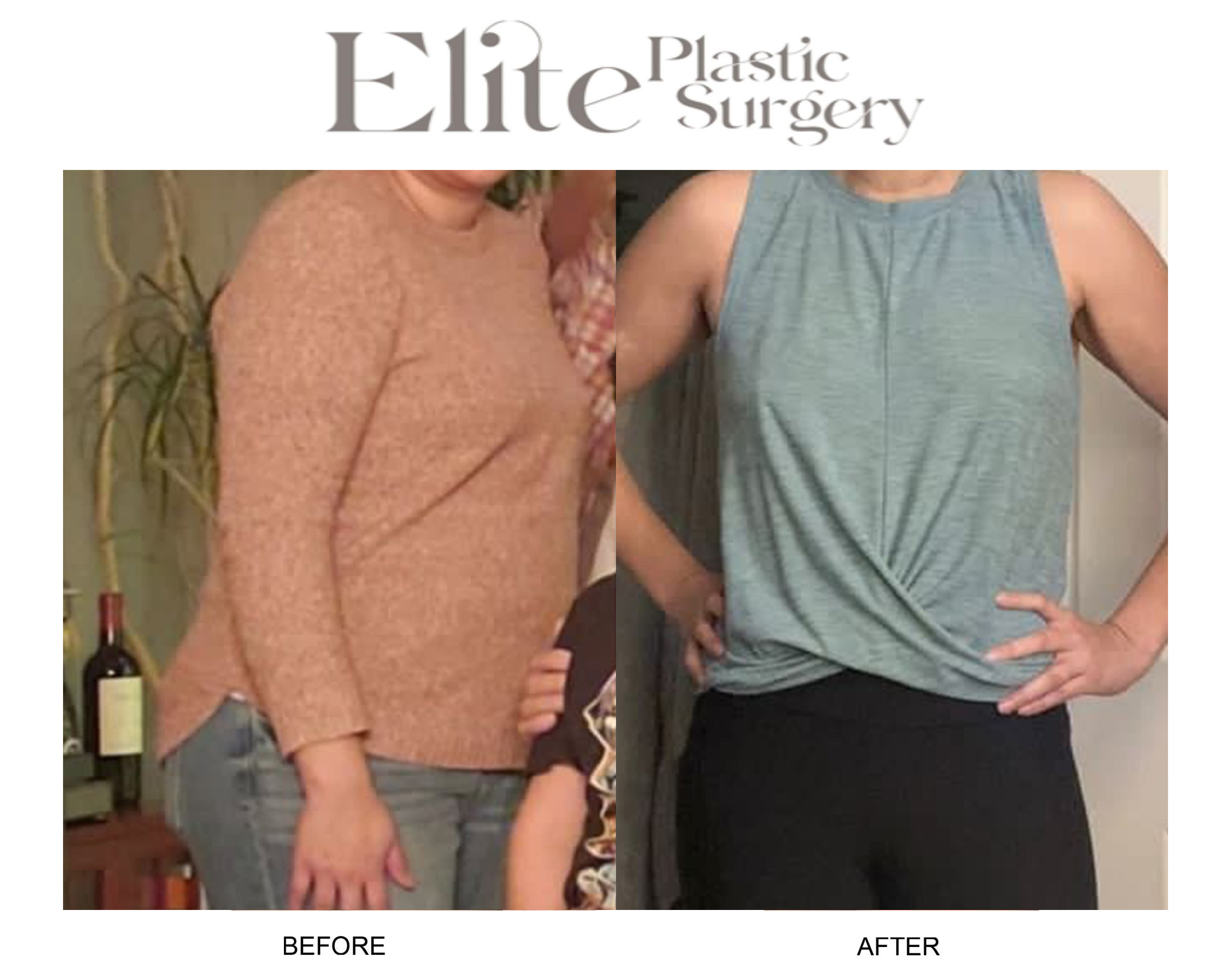 Weight Loss Shots Before & After Gallery - Patient 429154 - Image 1