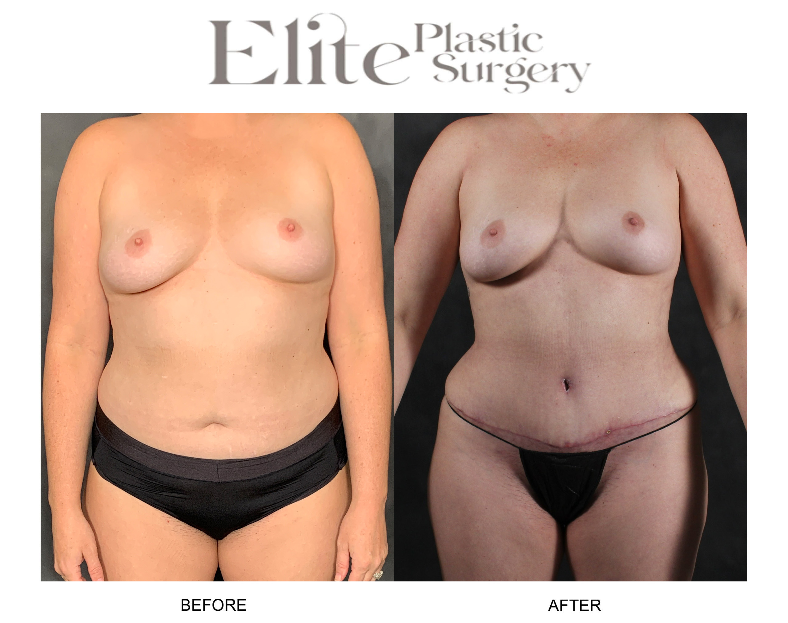 Liposuction Before & After Gallery - Patient 419962 - Image 1