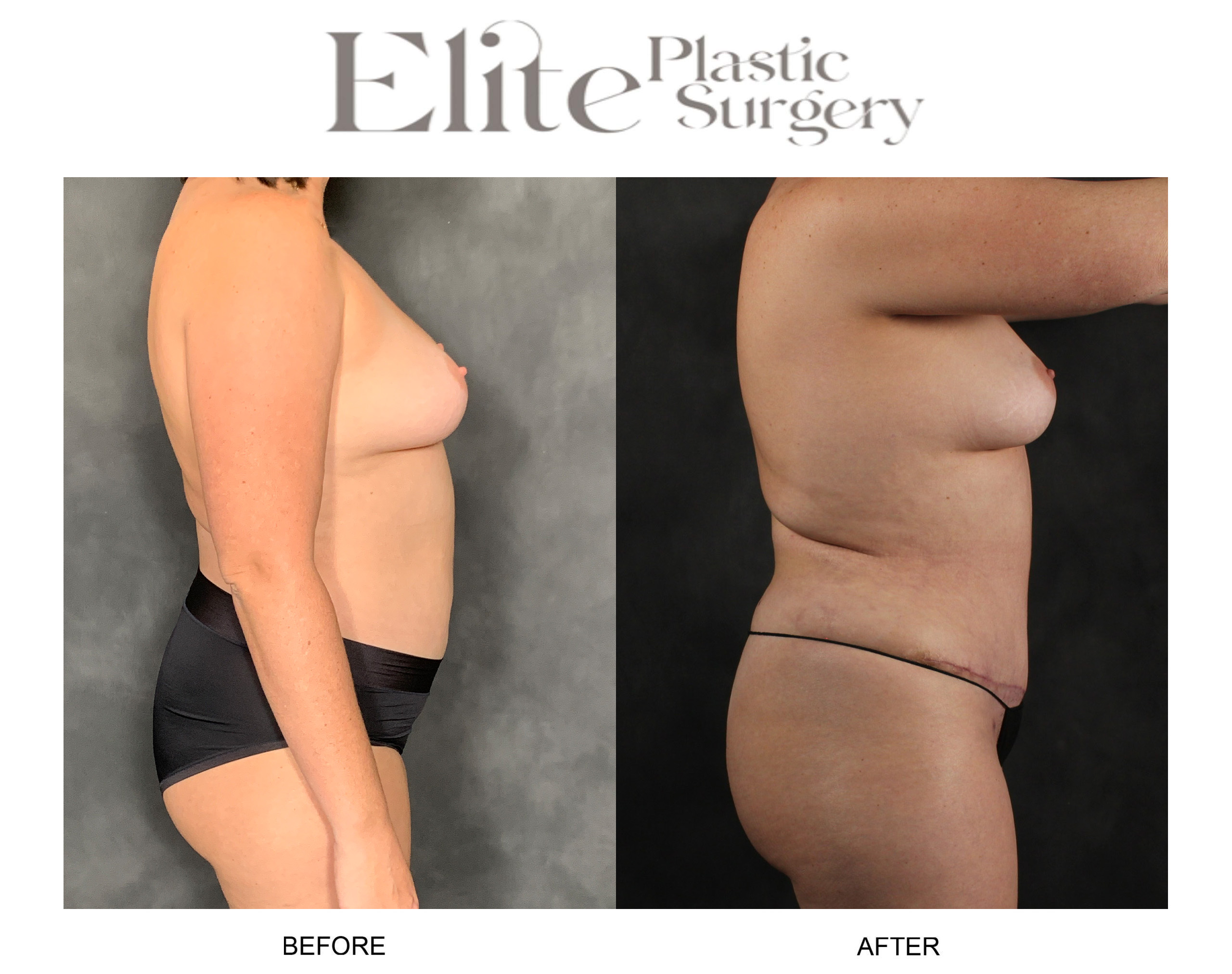 Abdominoplasty (Tummy Tuck) Before & After Gallery - Patient 210091 - Image 2