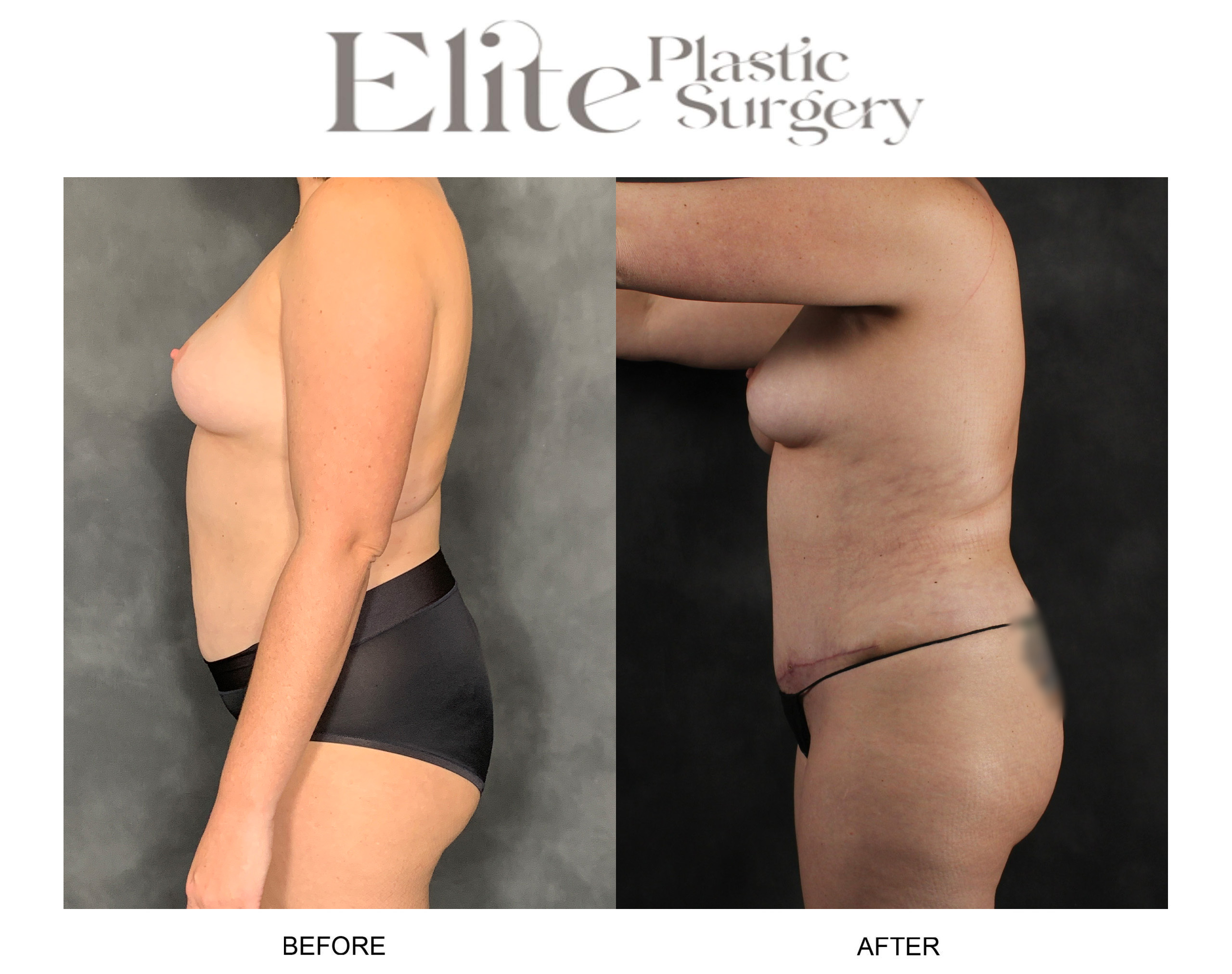 Abdominoplasty (Tummy Tuck) Before & After Gallery - Patient 210091 - Image 3