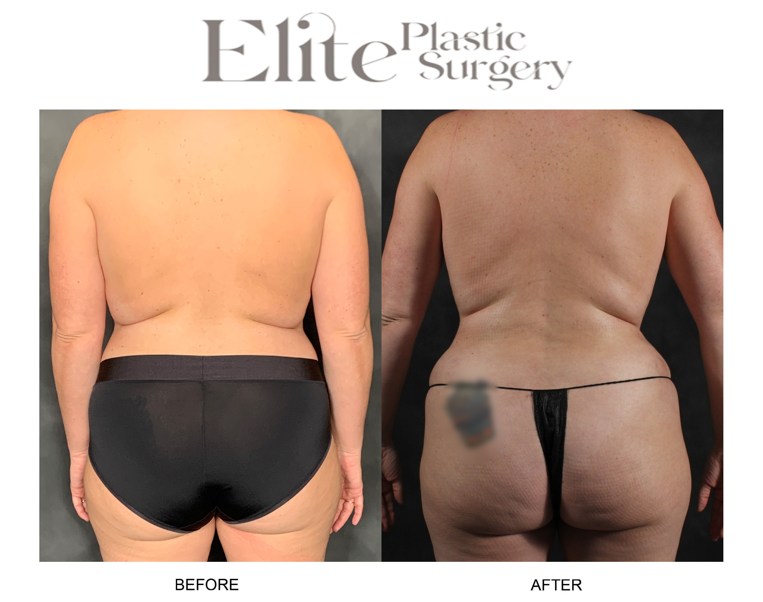 Abdominoplasty (Tummy Tuck) Before & After Gallery - Patient 210091 - Image 4