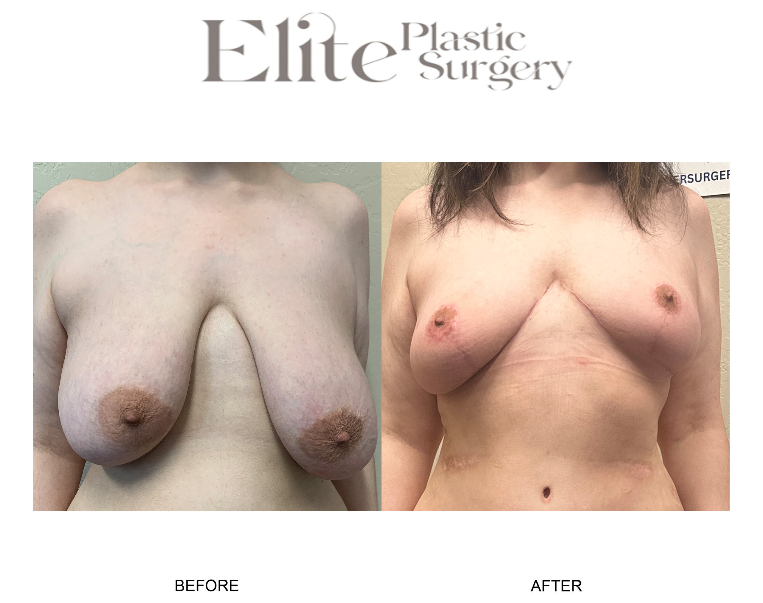 Breast Lift (Mastopexy) Before & After Gallery - Patient 395053 - Image 1