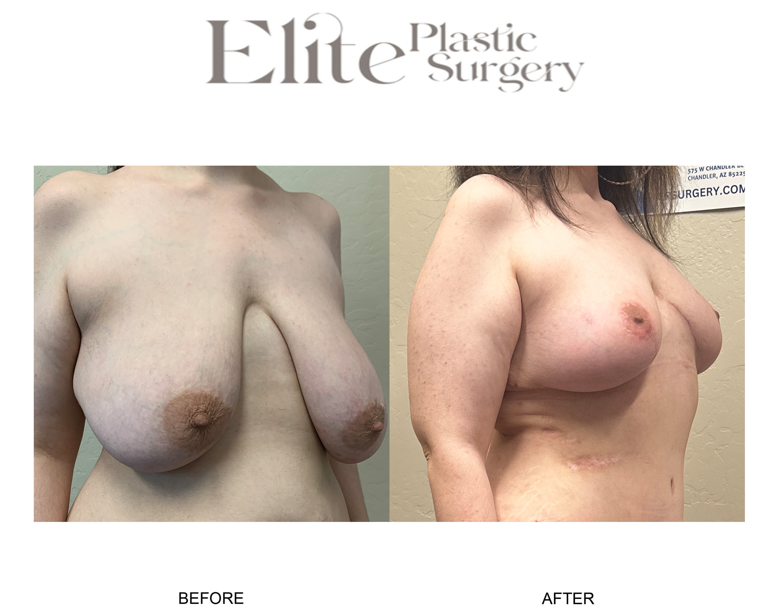 Breast Lift (Mastopexy) Before & After Gallery - Patient 395053 - Image 2