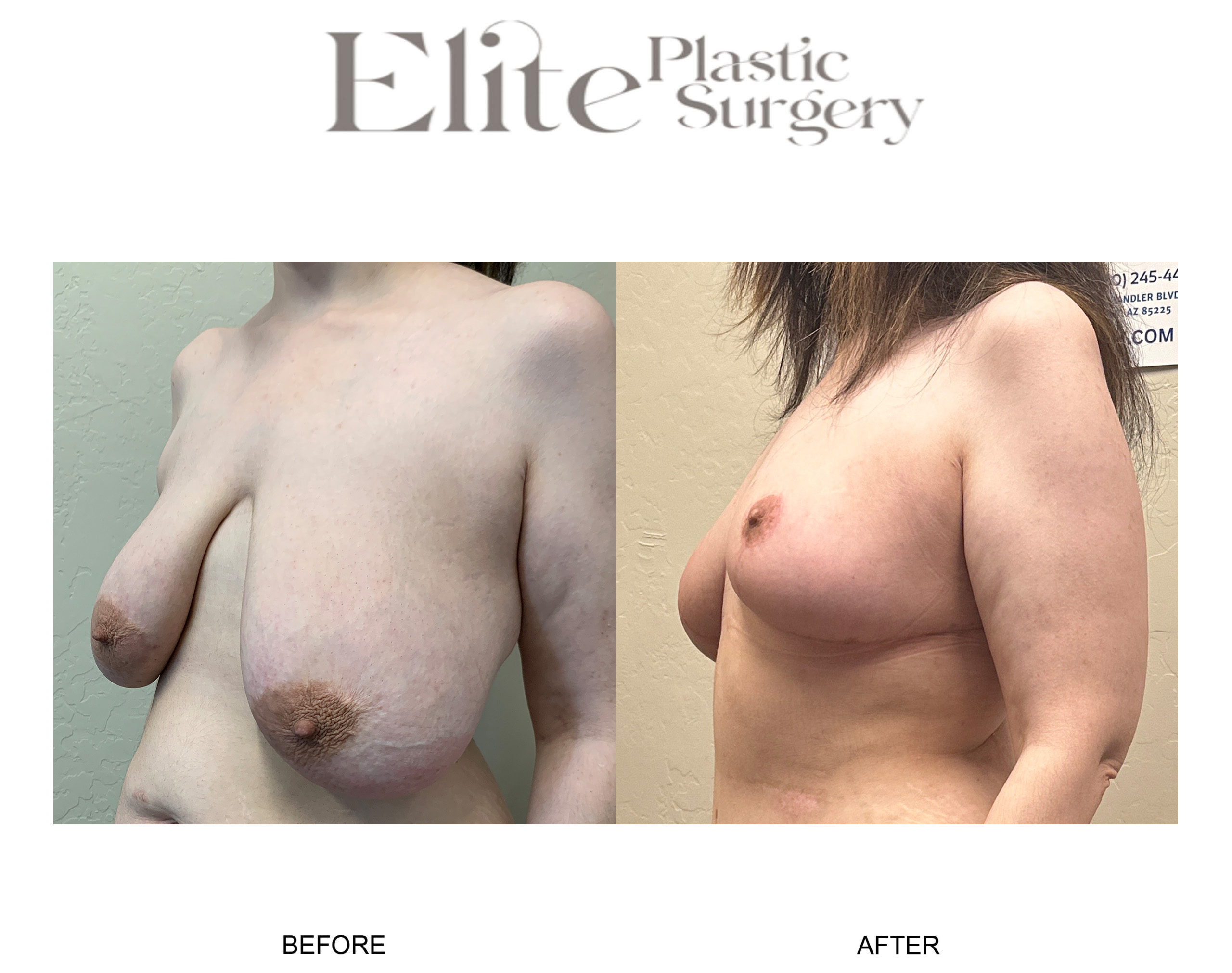 Breast Lift (Mastopexy) Before & After Gallery - Patient 395053 - Image 3