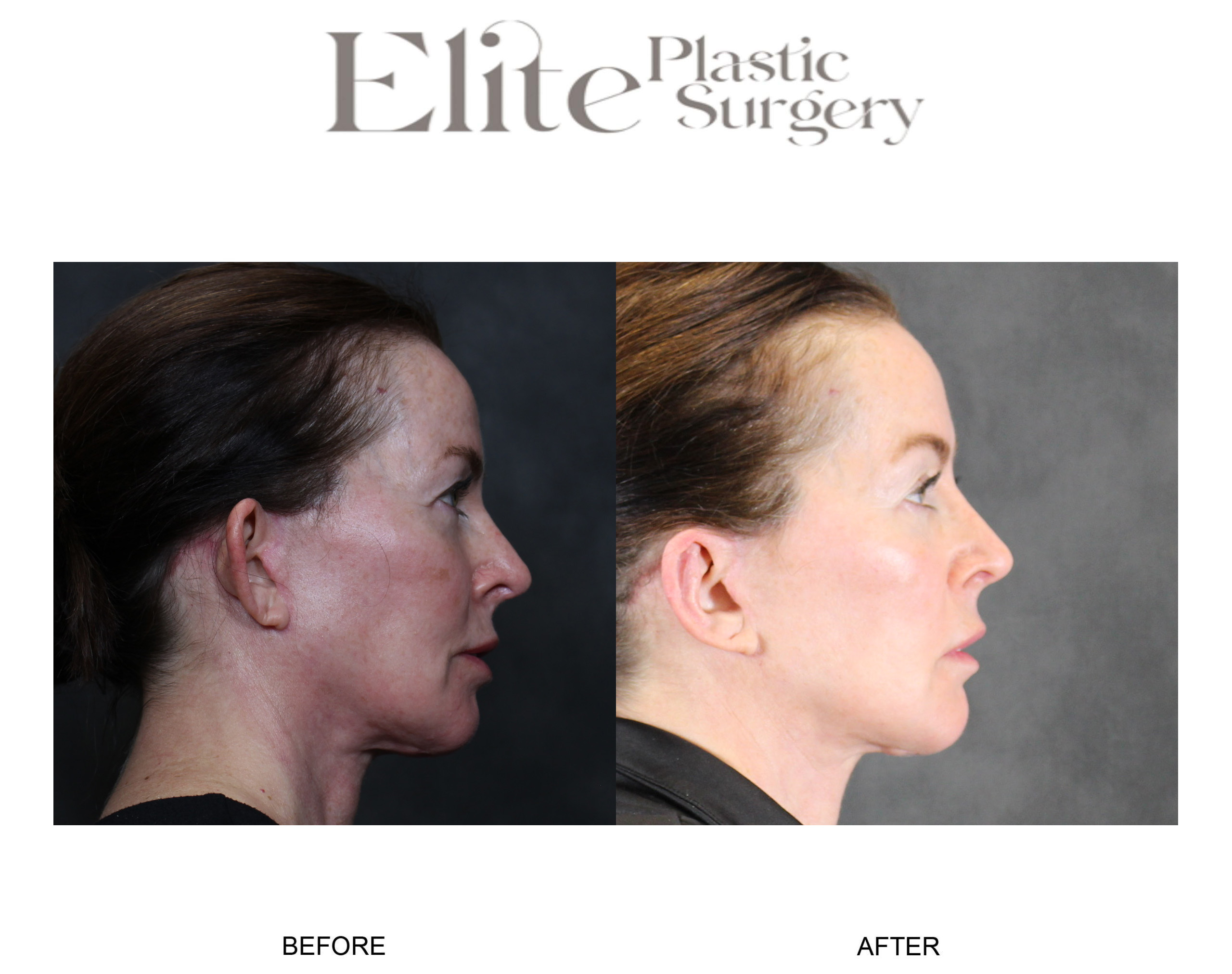Otoplasty Before & After Gallery - Patient 126861 - Image 1