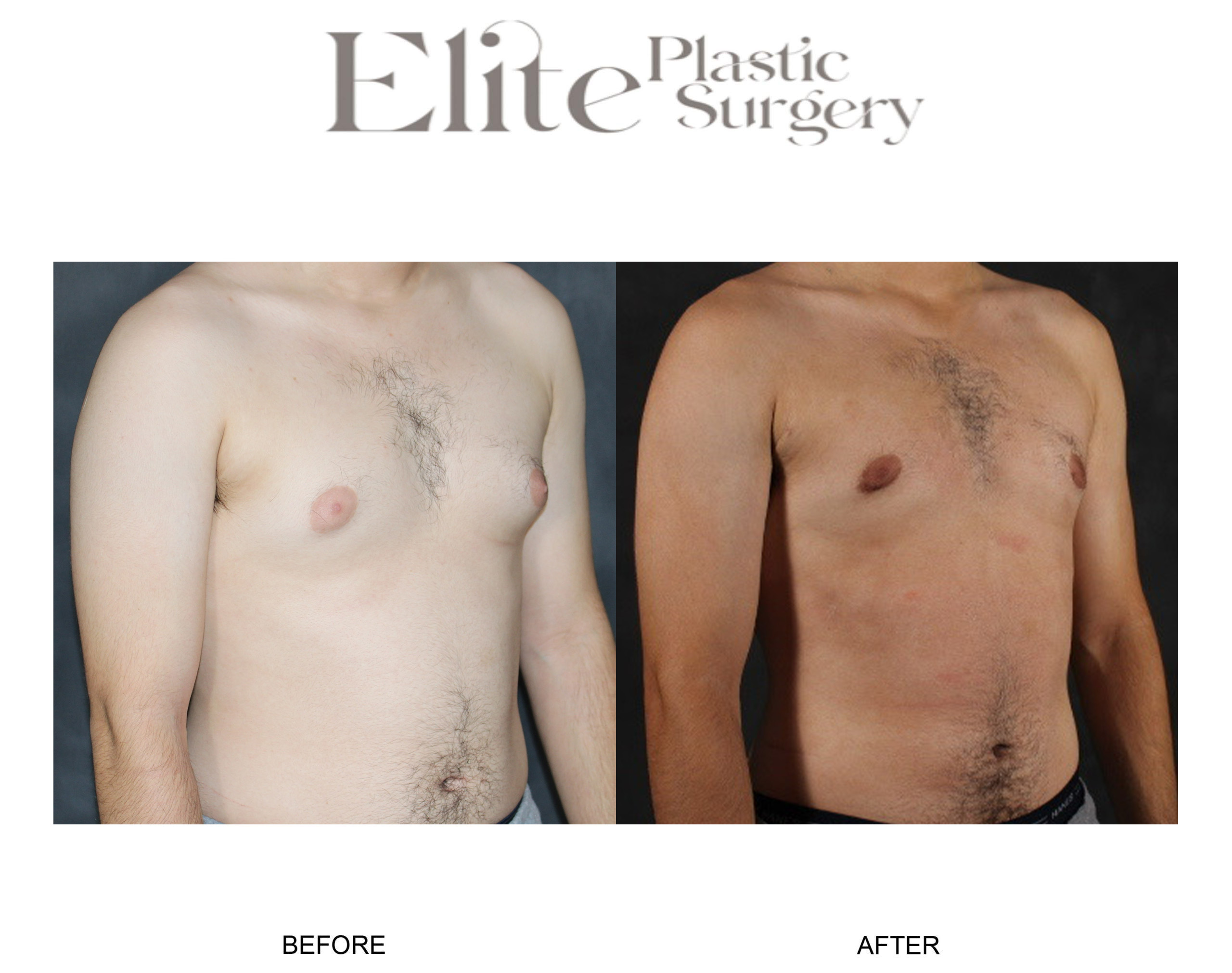 Male Gynecomastia Before & After Gallery - Patient 398859 - Image 1