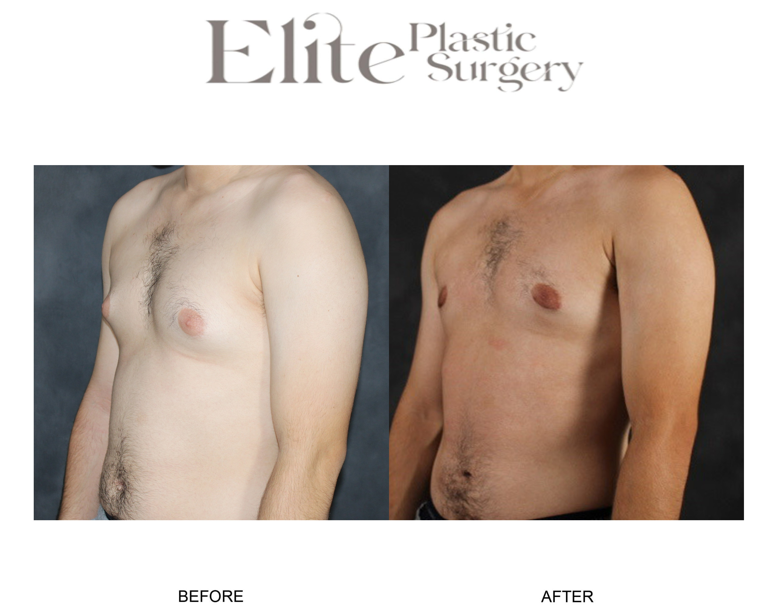 Male Gynecomastia Before & After Gallery - Patient 398859 - Image 2