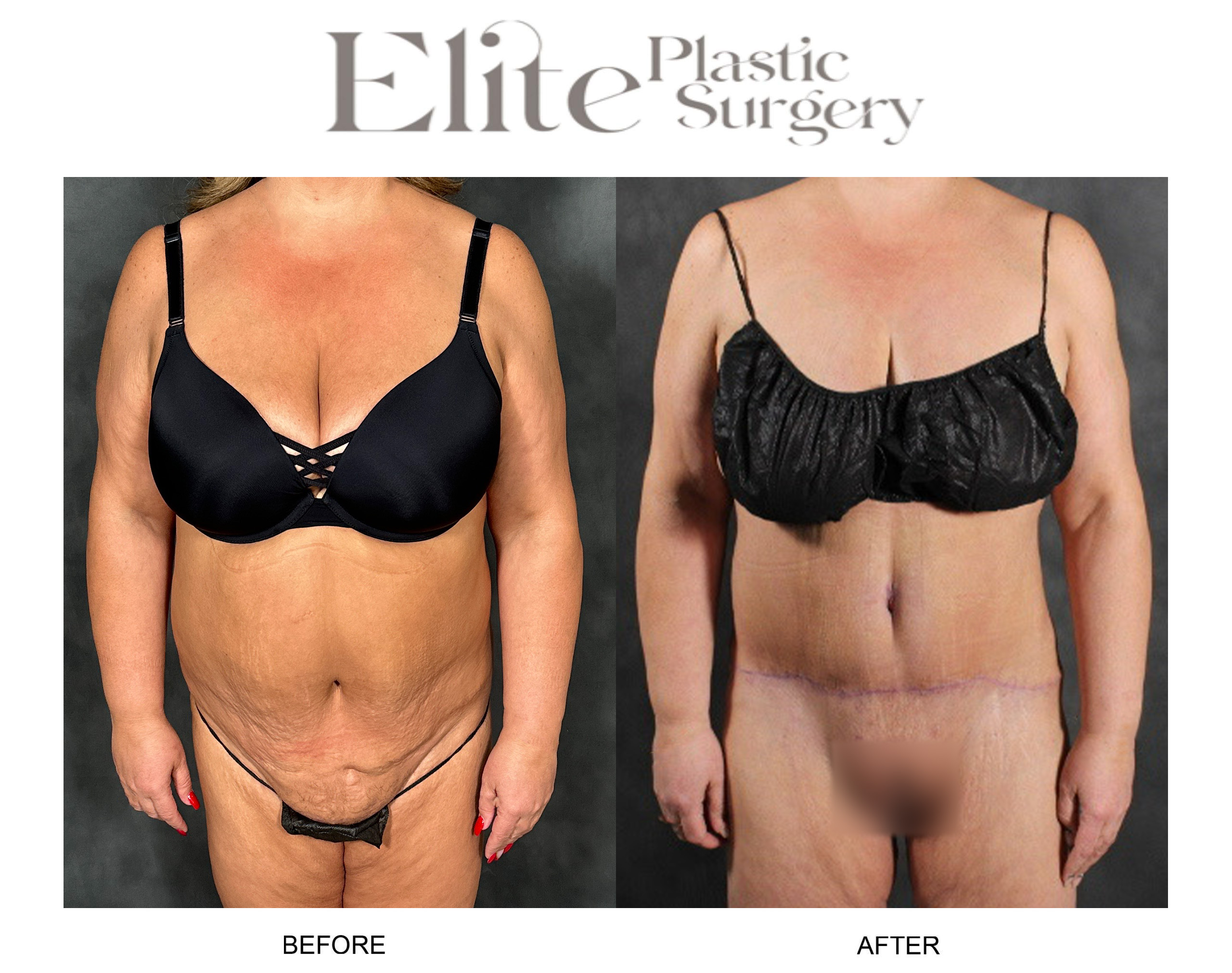 Abdominoplasty (Tummy Tuck) Before & After Gallery - Patient 103378 - Image 1