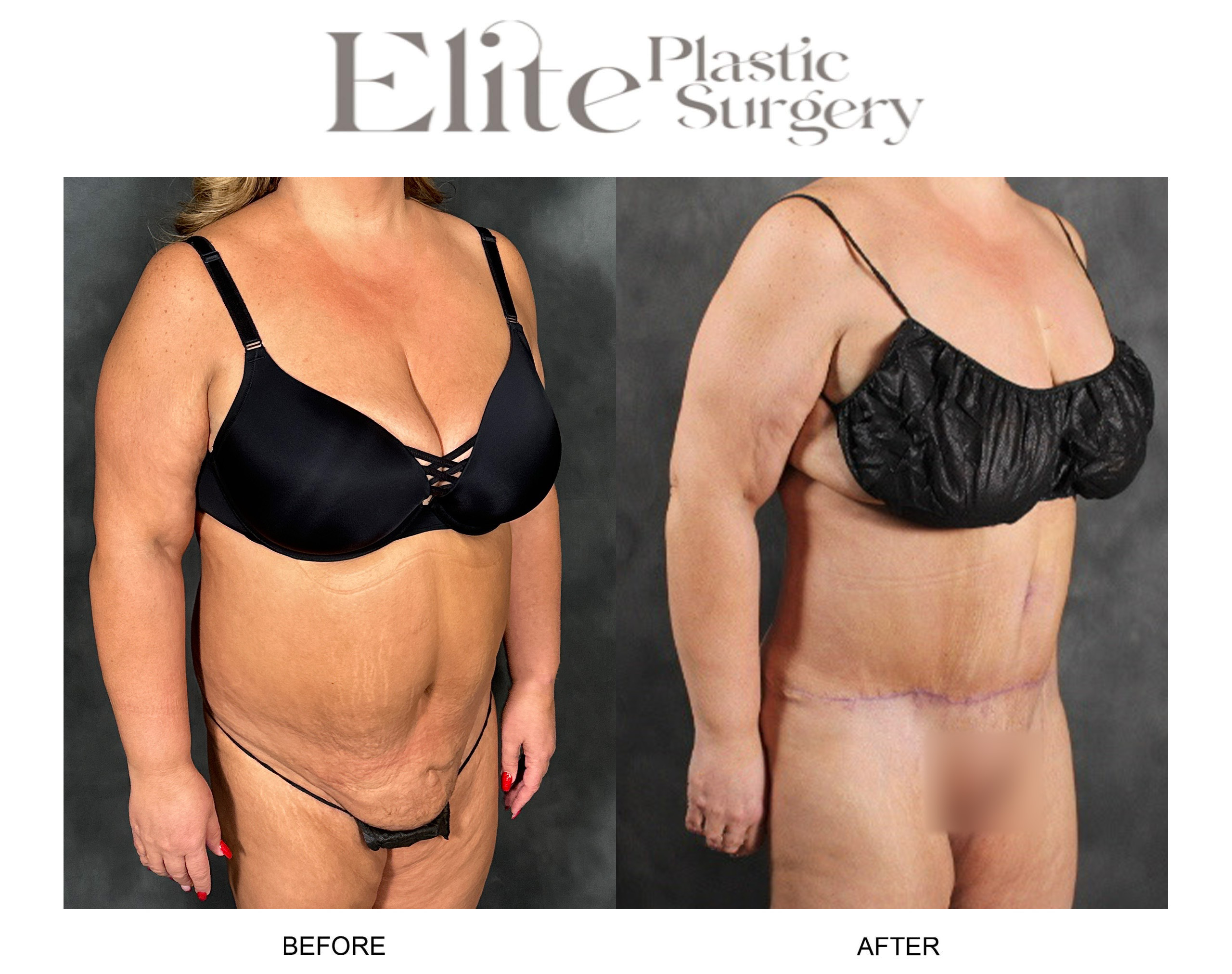 Abdominoplasty (Tummy Tuck) Before & After Gallery - Patient 103378 - Image 2