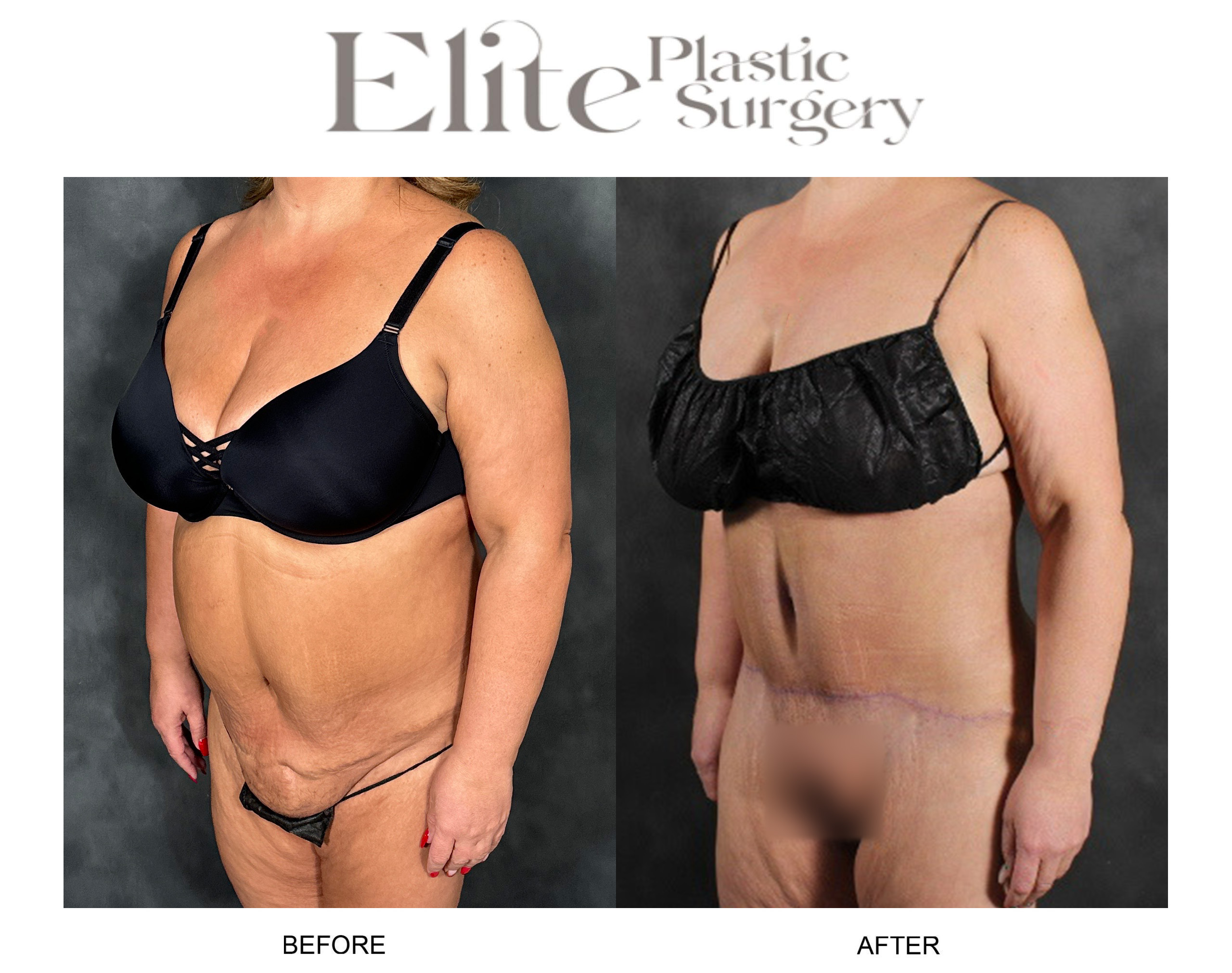 Abdominoplasty (Tummy Tuck) Before & After Gallery - Patient 103378 - Image 3