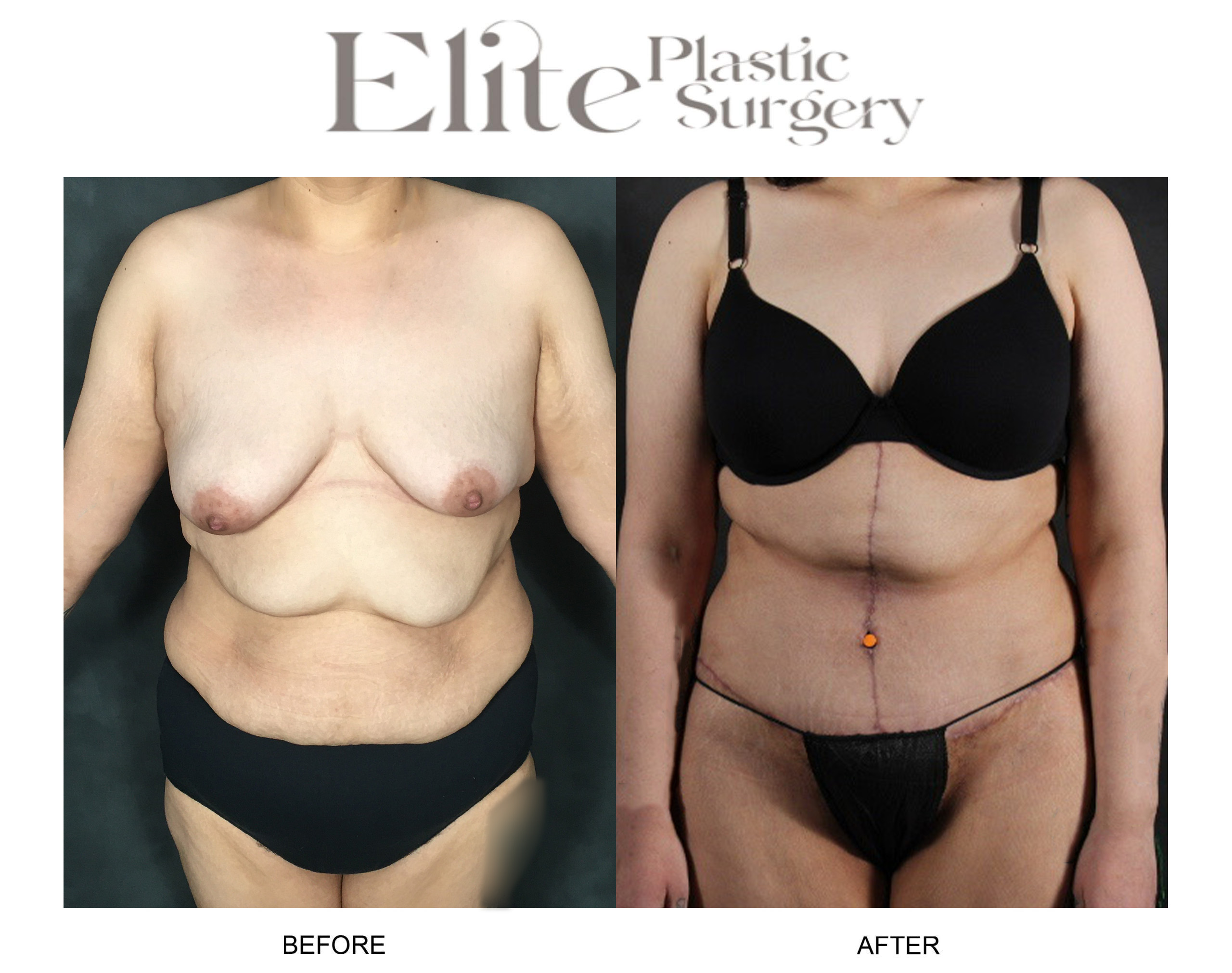 Abdominoplasty (Tummy Tuck) Before & After Gallery - Patient 416196 - Image 1