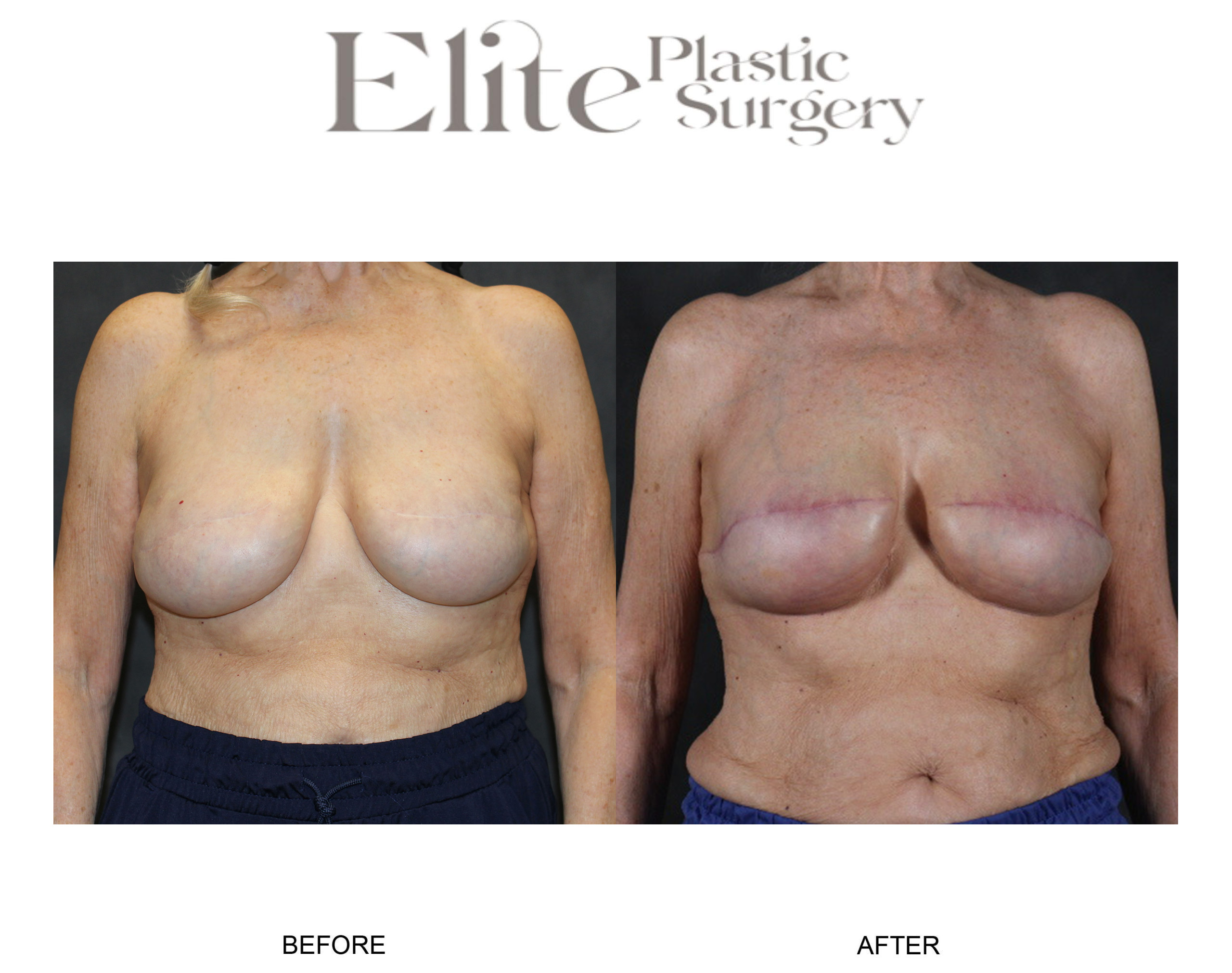 Breast Lift (Mastopexy) Before & After Gallery - Patient 229430 - Image 1