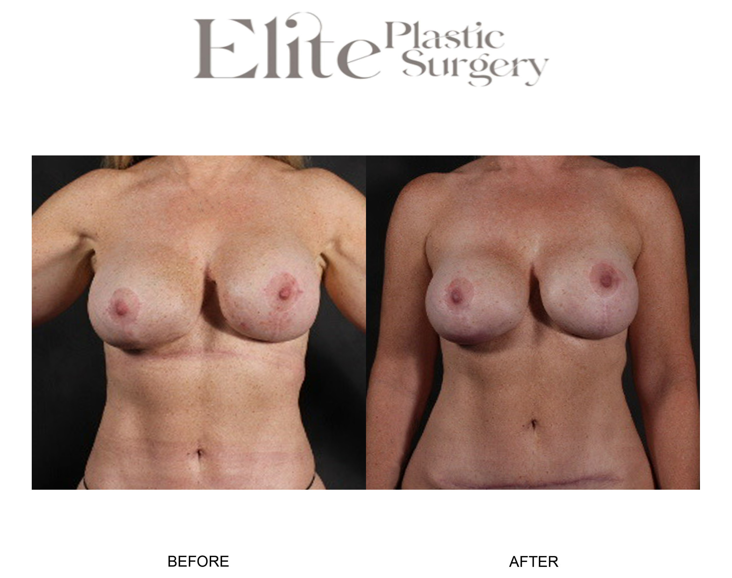 Breast Augmentation Before & After Gallery - Patient 148161 - Image 1