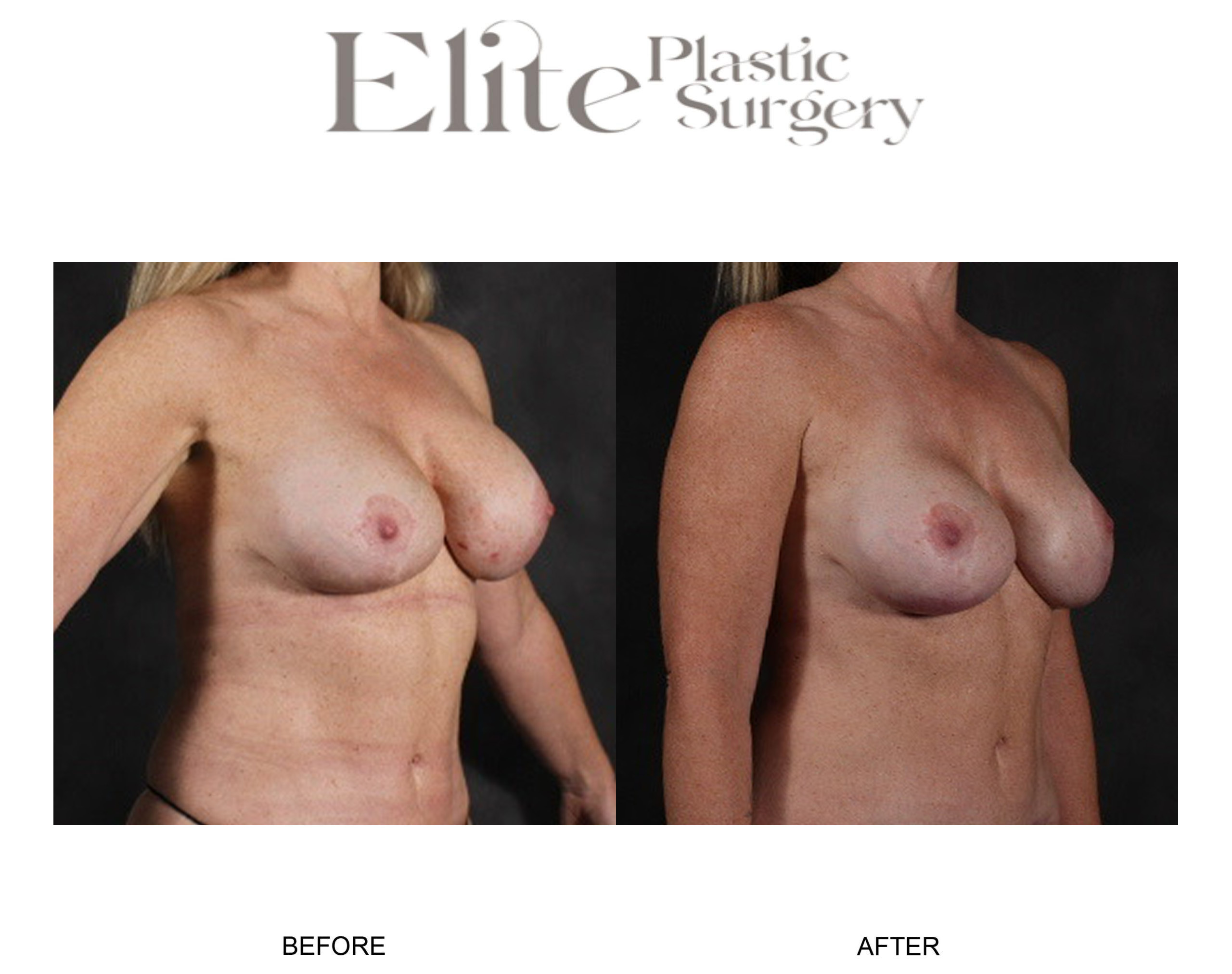 Breast Augmentation Before & After Gallery - Patient 148161 - Image 3