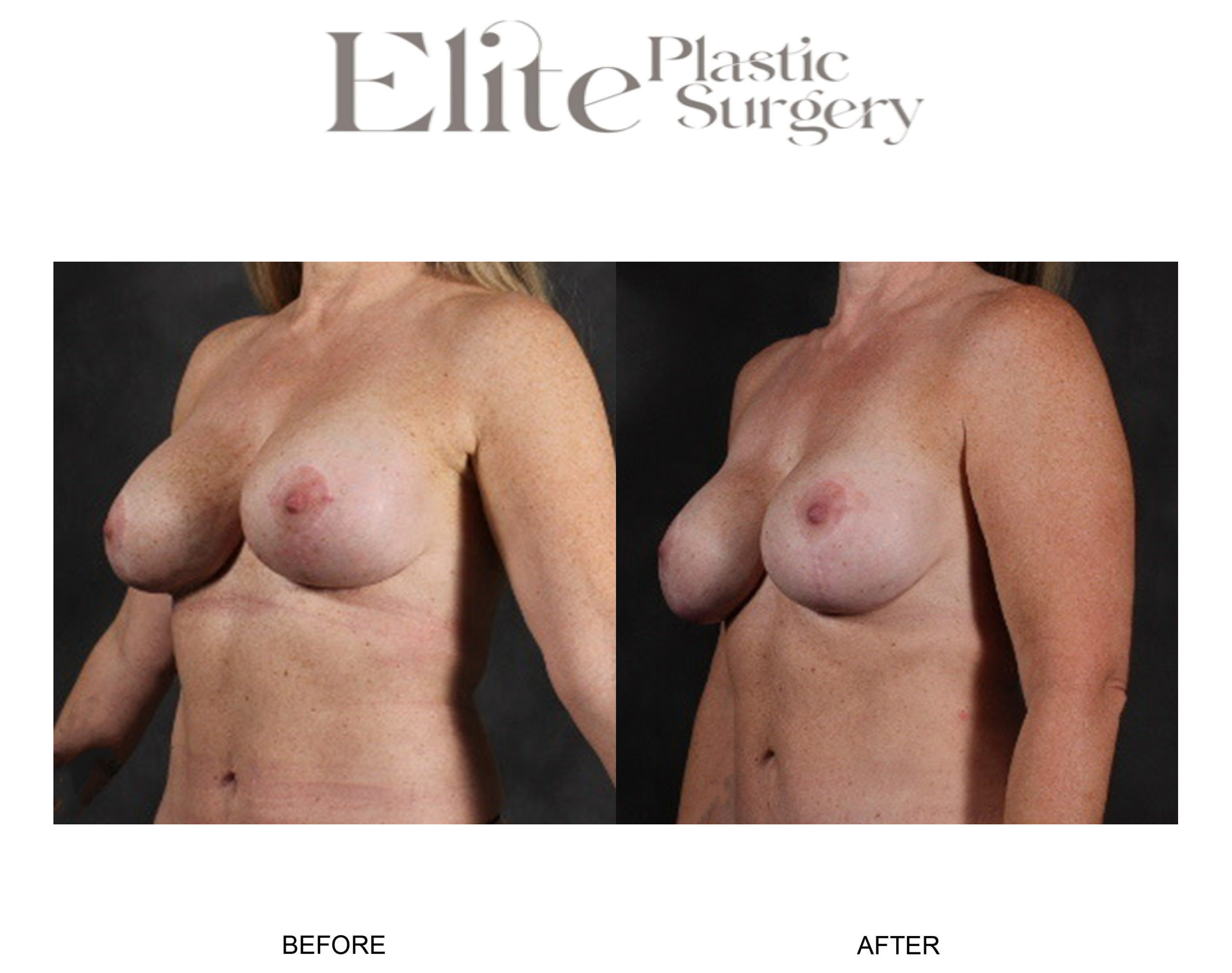 Breast Augmentation Before & After Gallery - Patient 148161 - Image 2