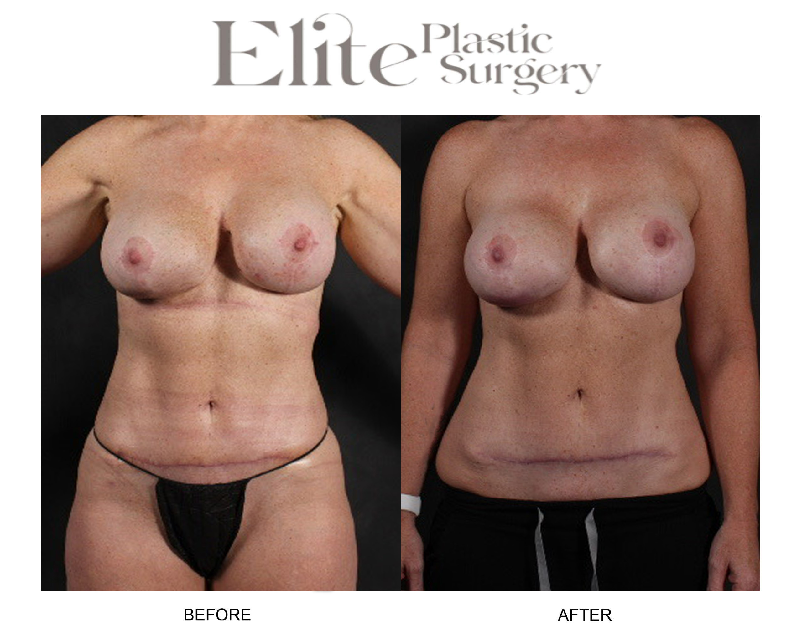 Liposuction Before & After Gallery - Patient 245928 - Image 1